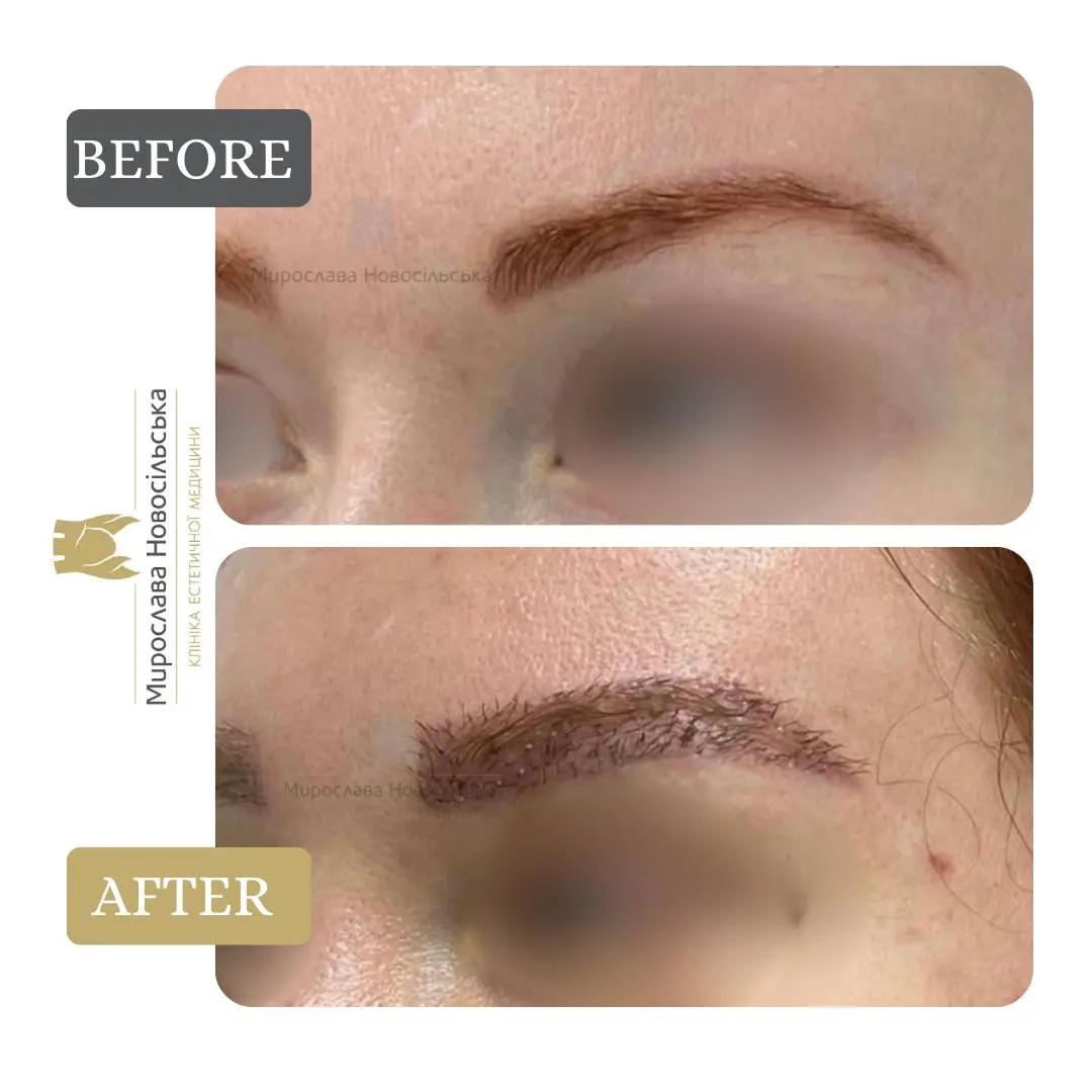 Eyebrow transplant, photo 7