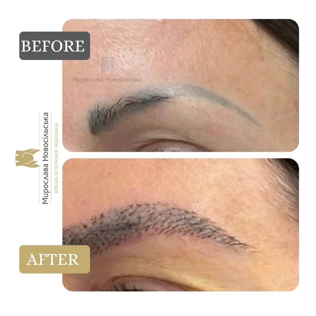 Eyebrow transplant, photo 8