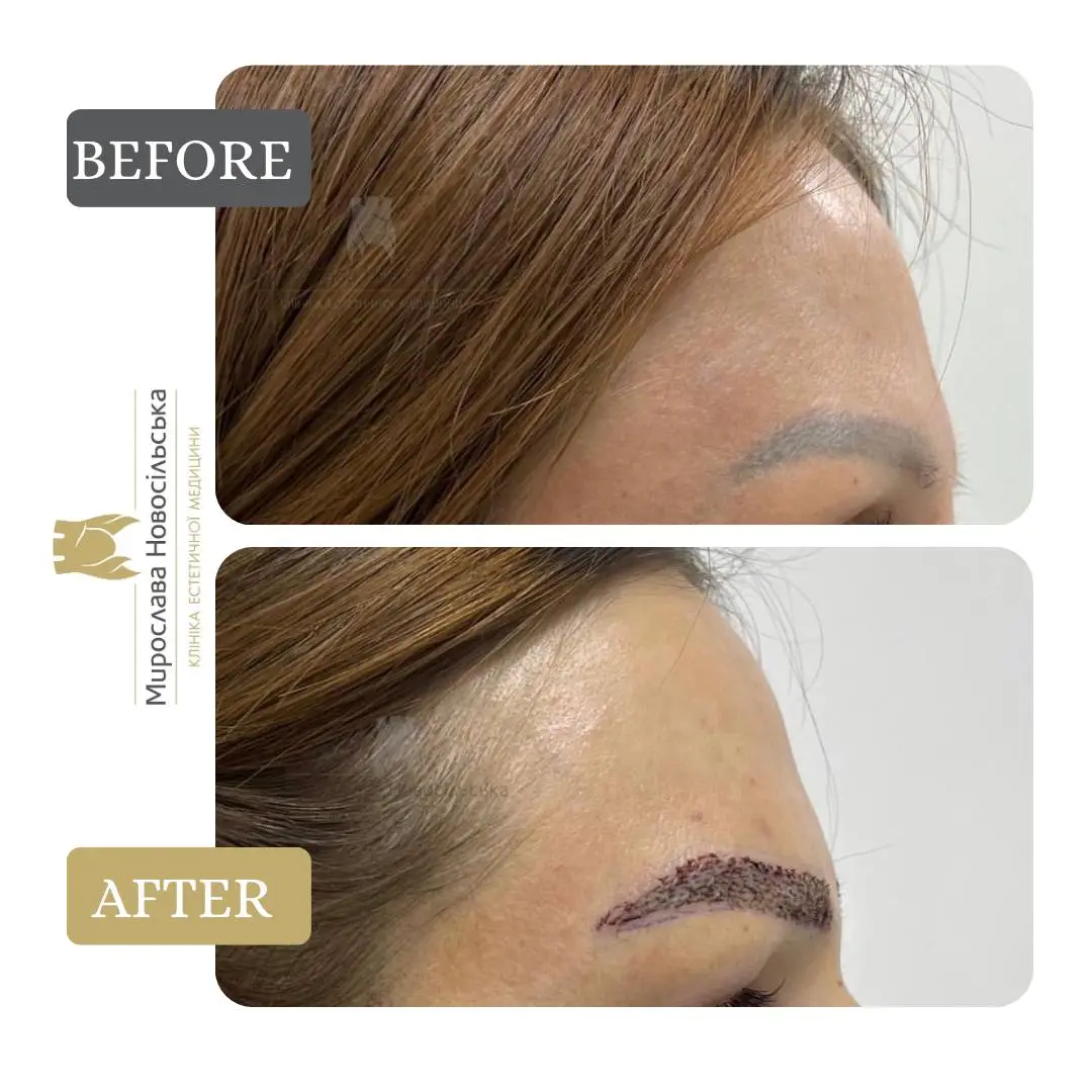 Eyebrow transplant, photo 9