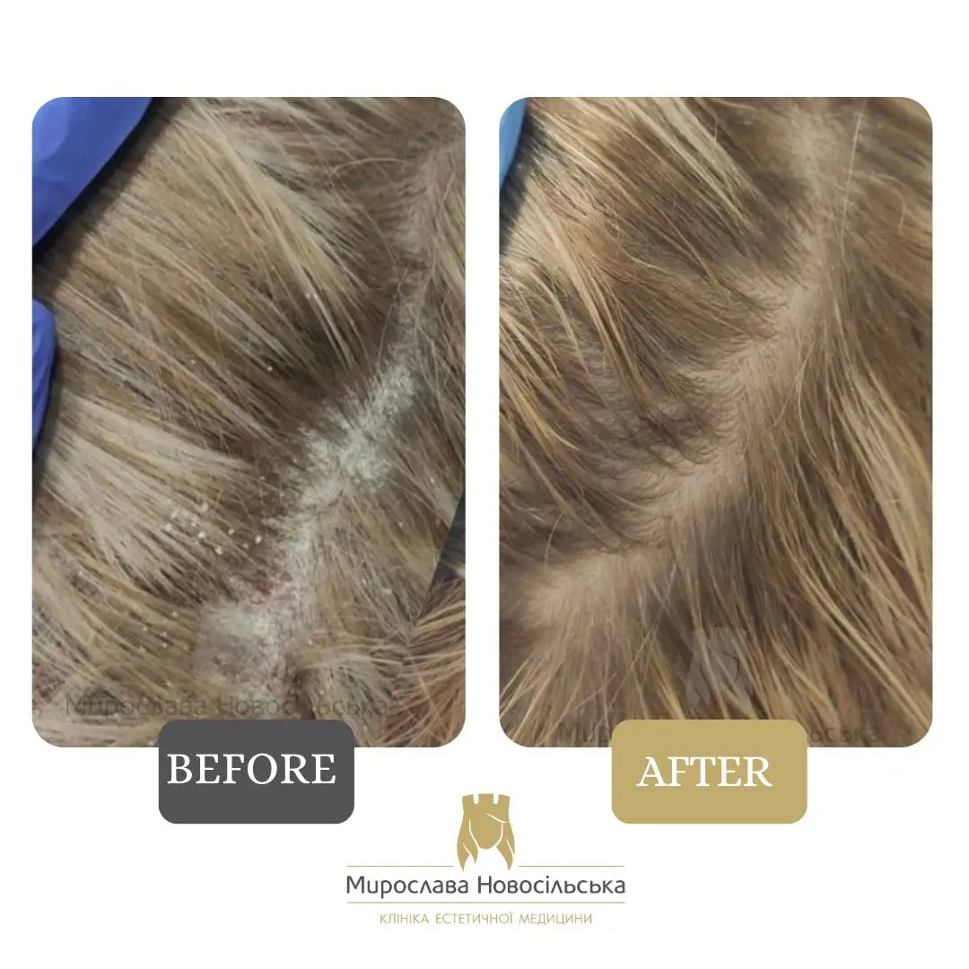 Scalp peeling, photo 3