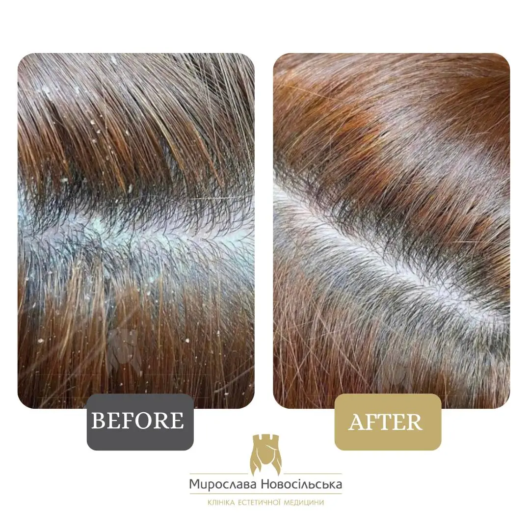 Scalp peeling, photo 2