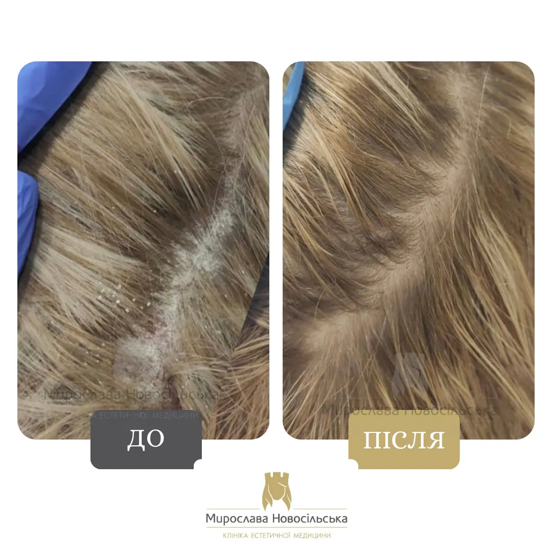 Пілінг шкіри голови, фото 3