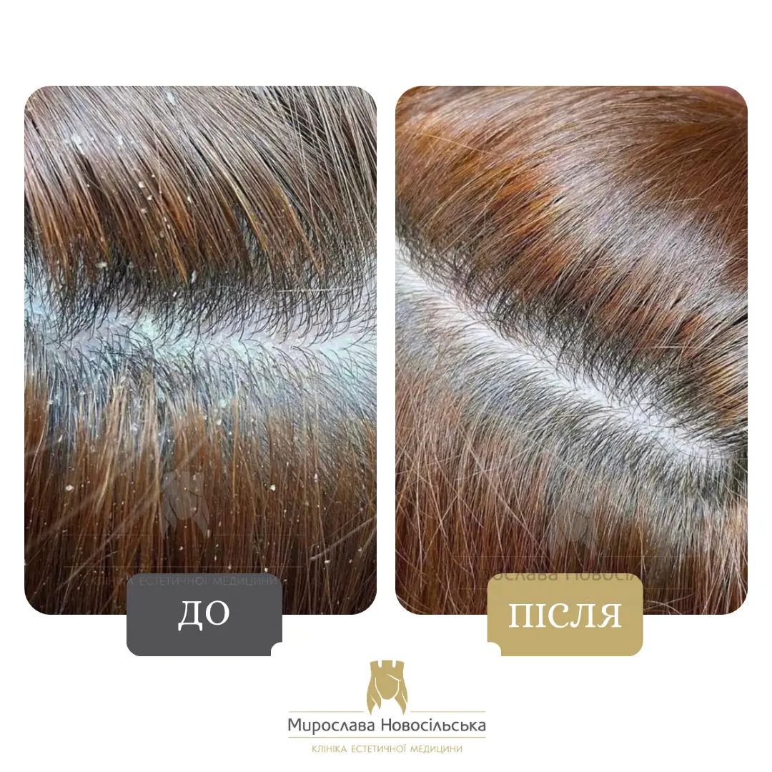 Пілінг шкіри голови, фото 2