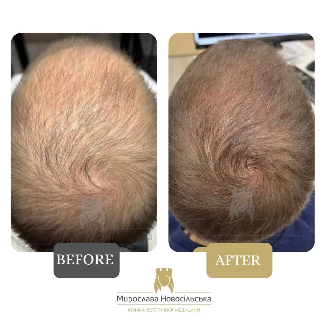Scalp plasma therapy