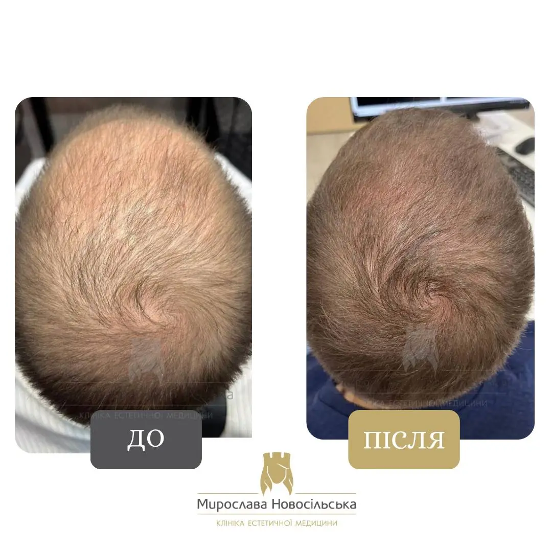 Плазмотерапія шкіри голови, фото 3