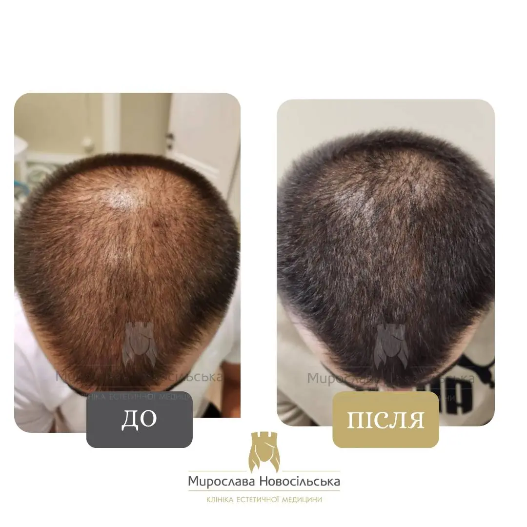 Плазмотерапія шкіри голови, фото 4