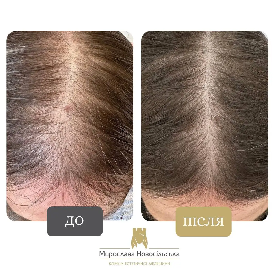 Плазмотерапія шкіри голови, фото 2
