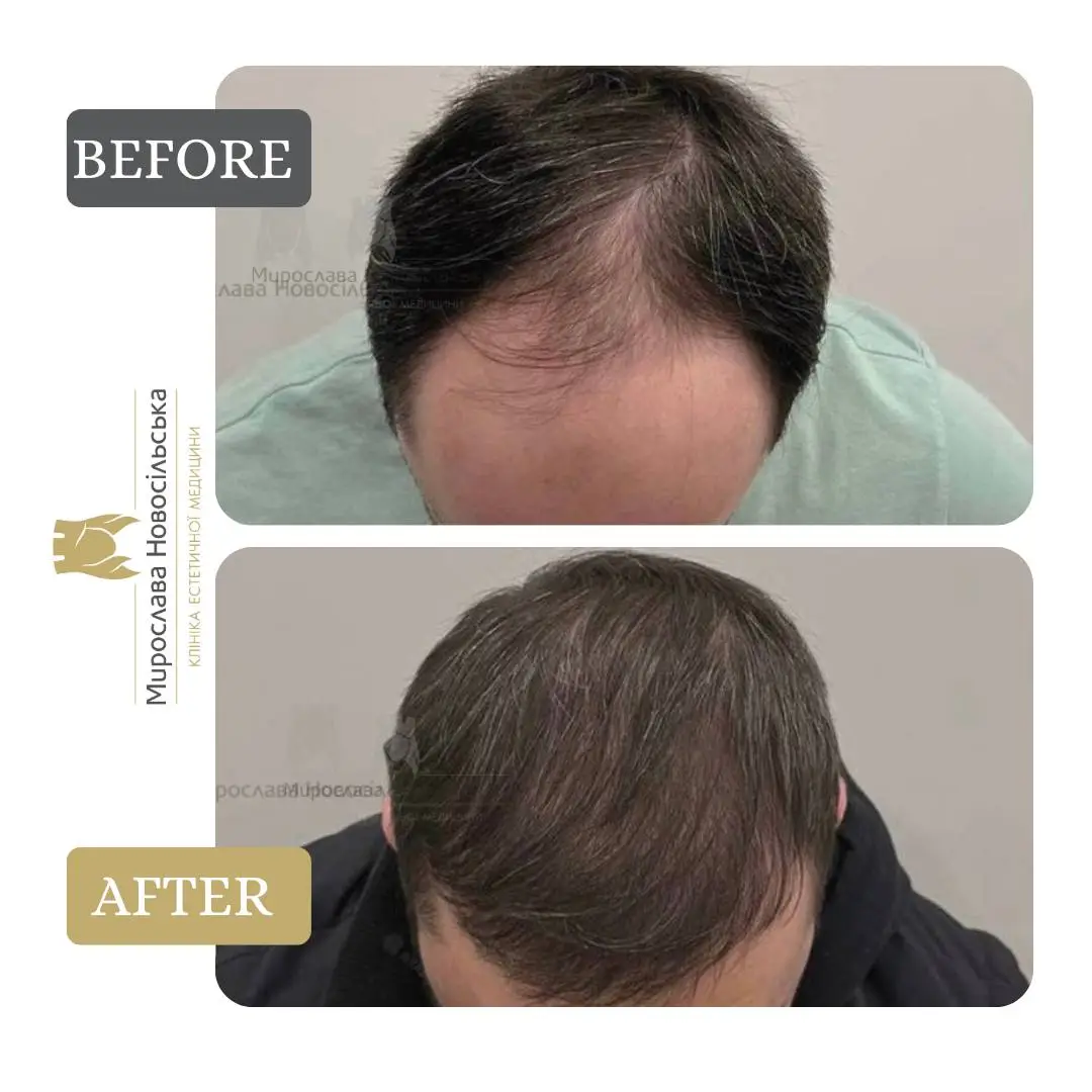 Hair transplantation by the FUE method, photo 2
