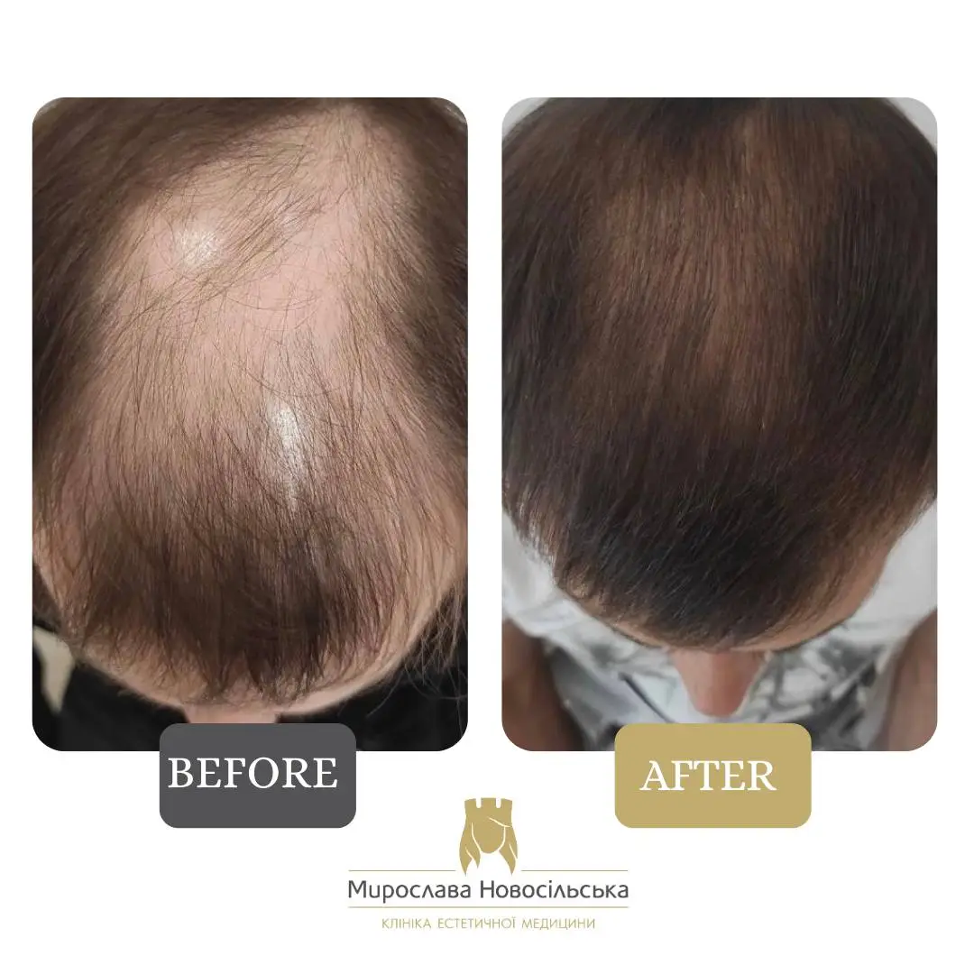 Hair transplantation by the FUE method, photo 7