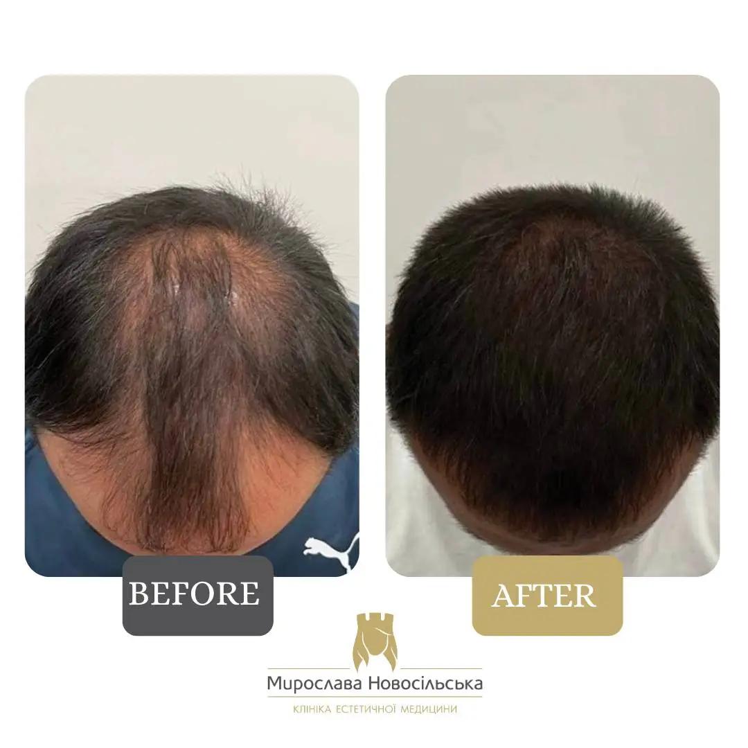Hair transplantation by the FUE method