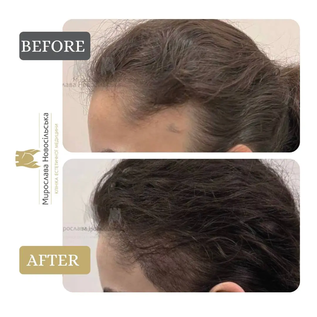 Hair transplantation by the FUE method, photo 4