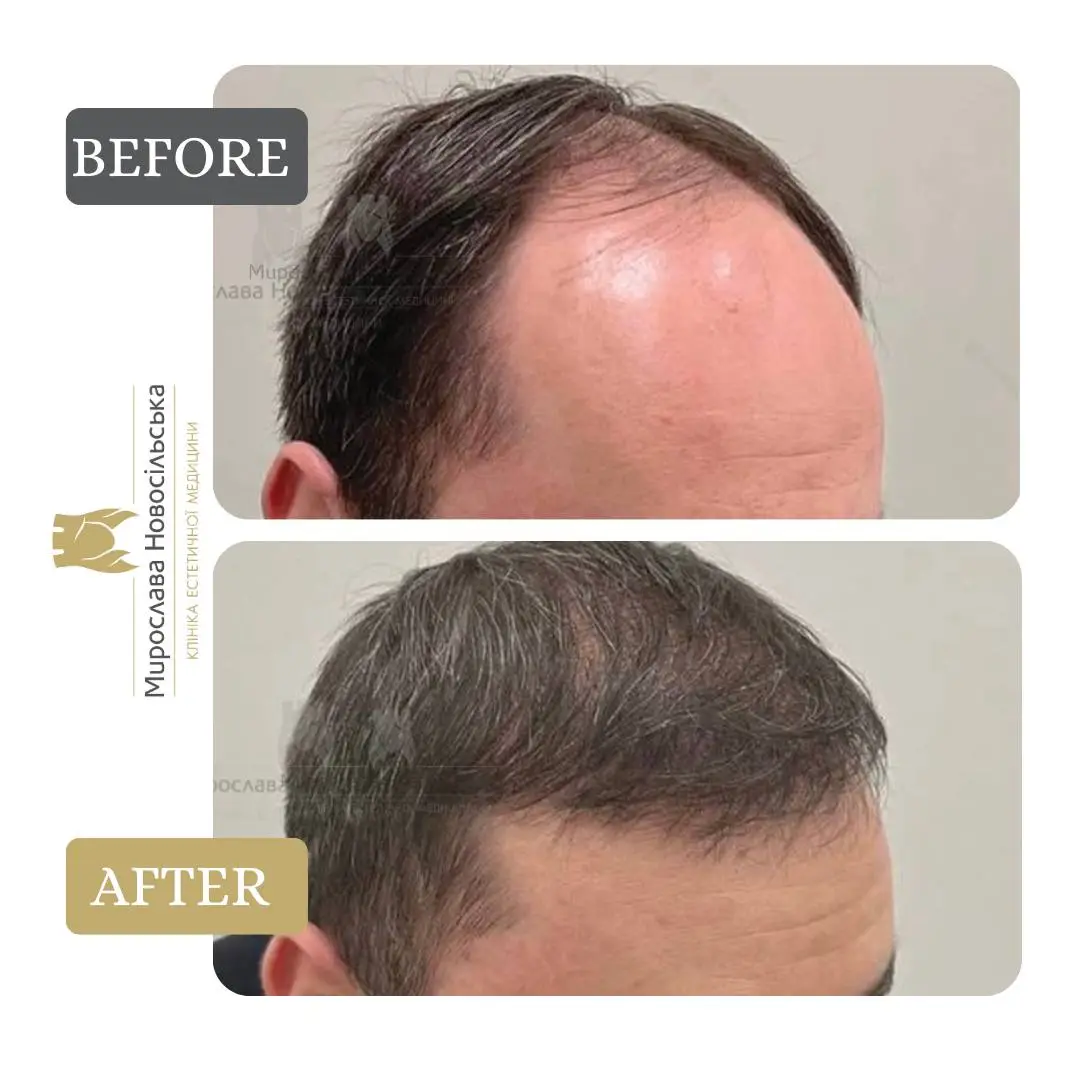 Hair transplantation by the FUE method, photo 5