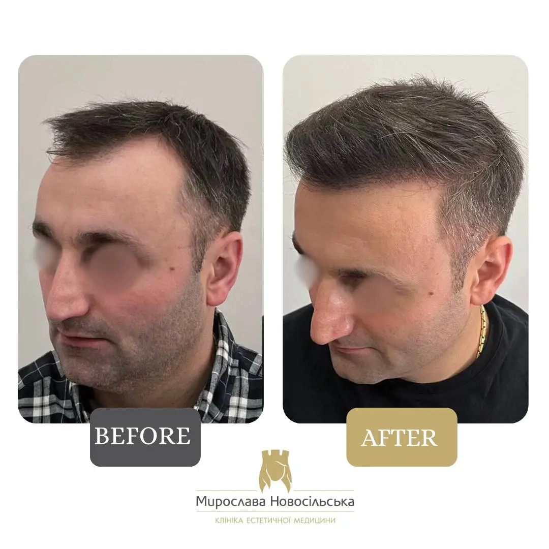 Hair transplantation by the FUE method, photo 6