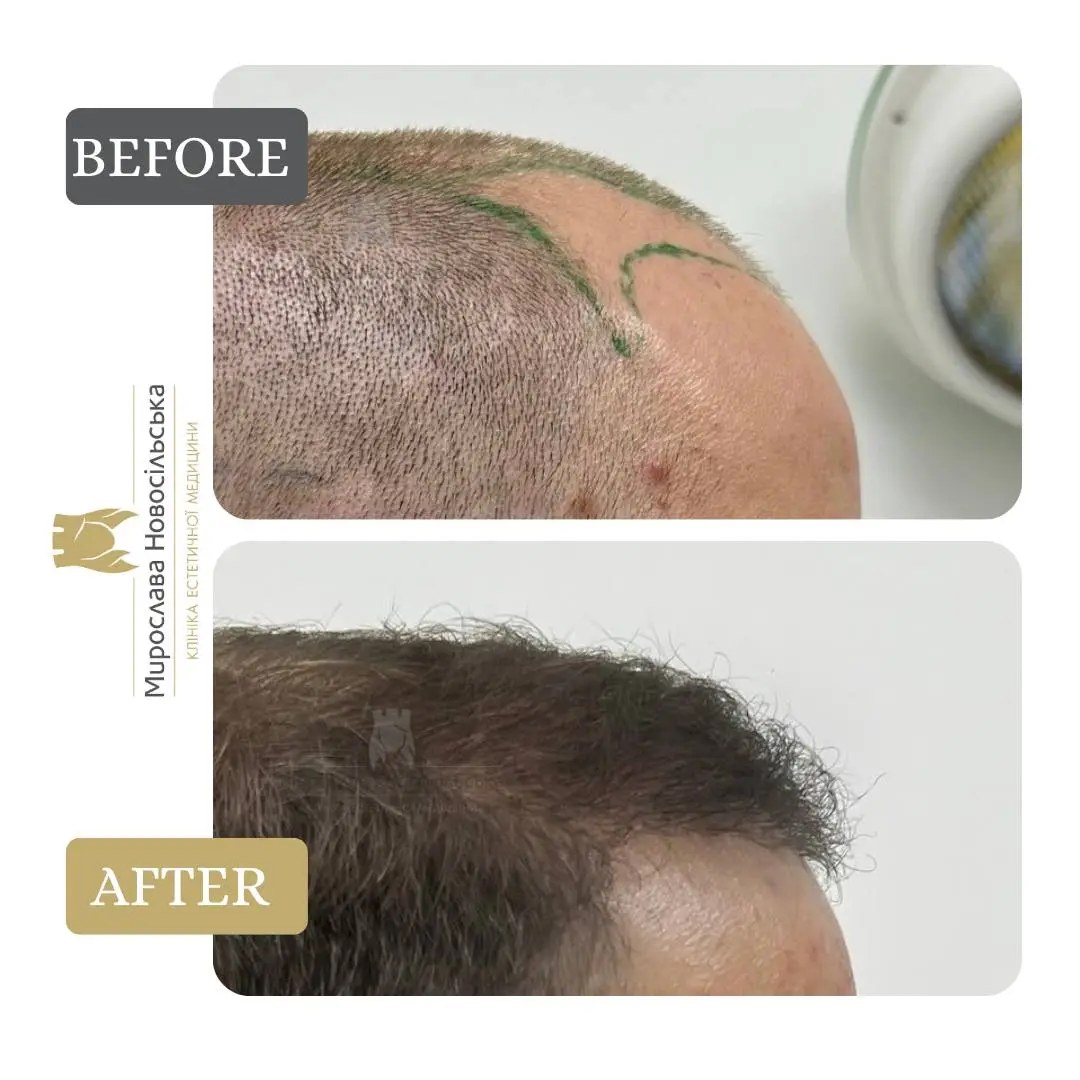 Hair transplantation by the FUE method, photo 8