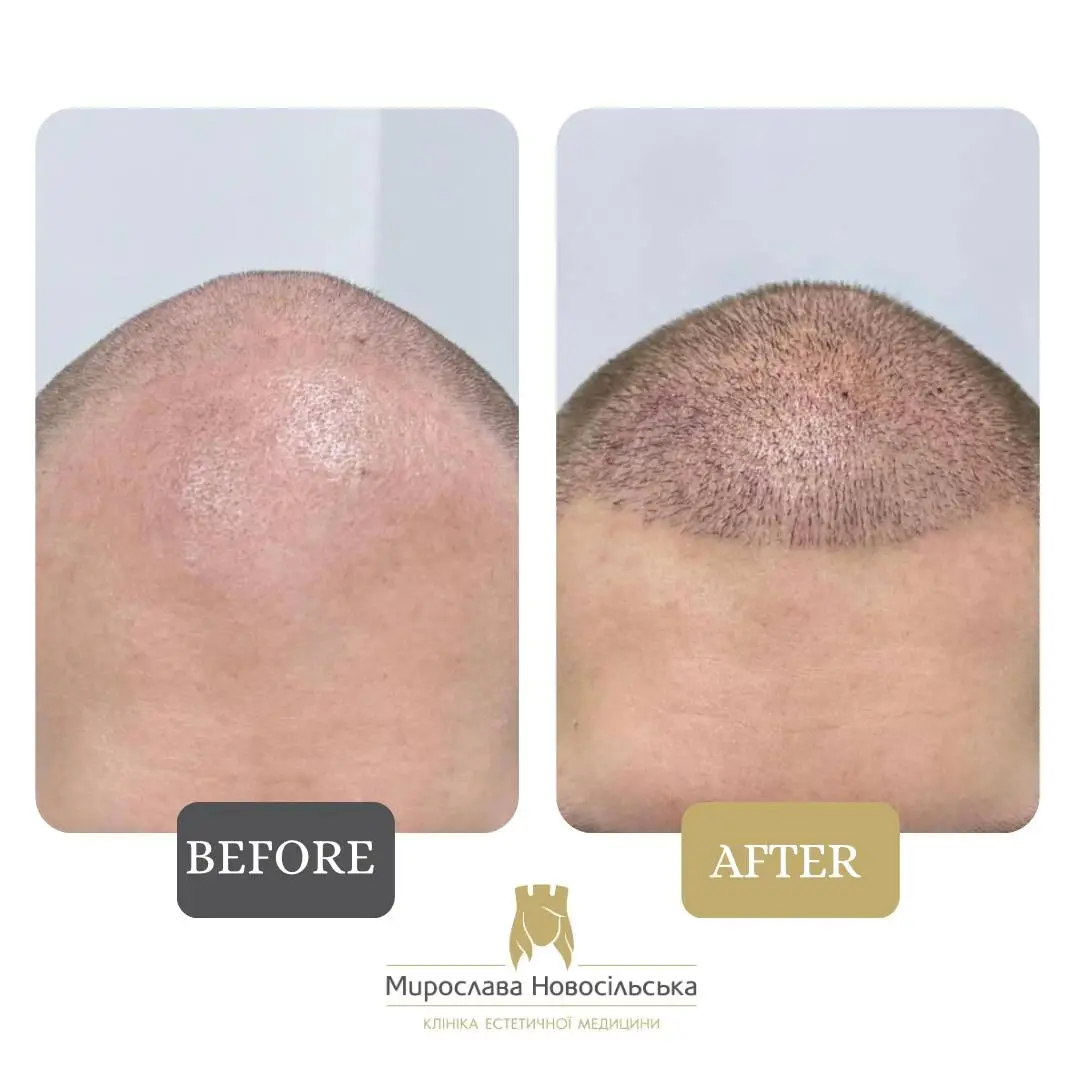 Hair transplantation by the FUE method, photo 9