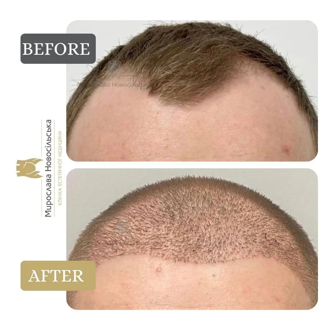Hair transplantation by the FUE method, photo 10