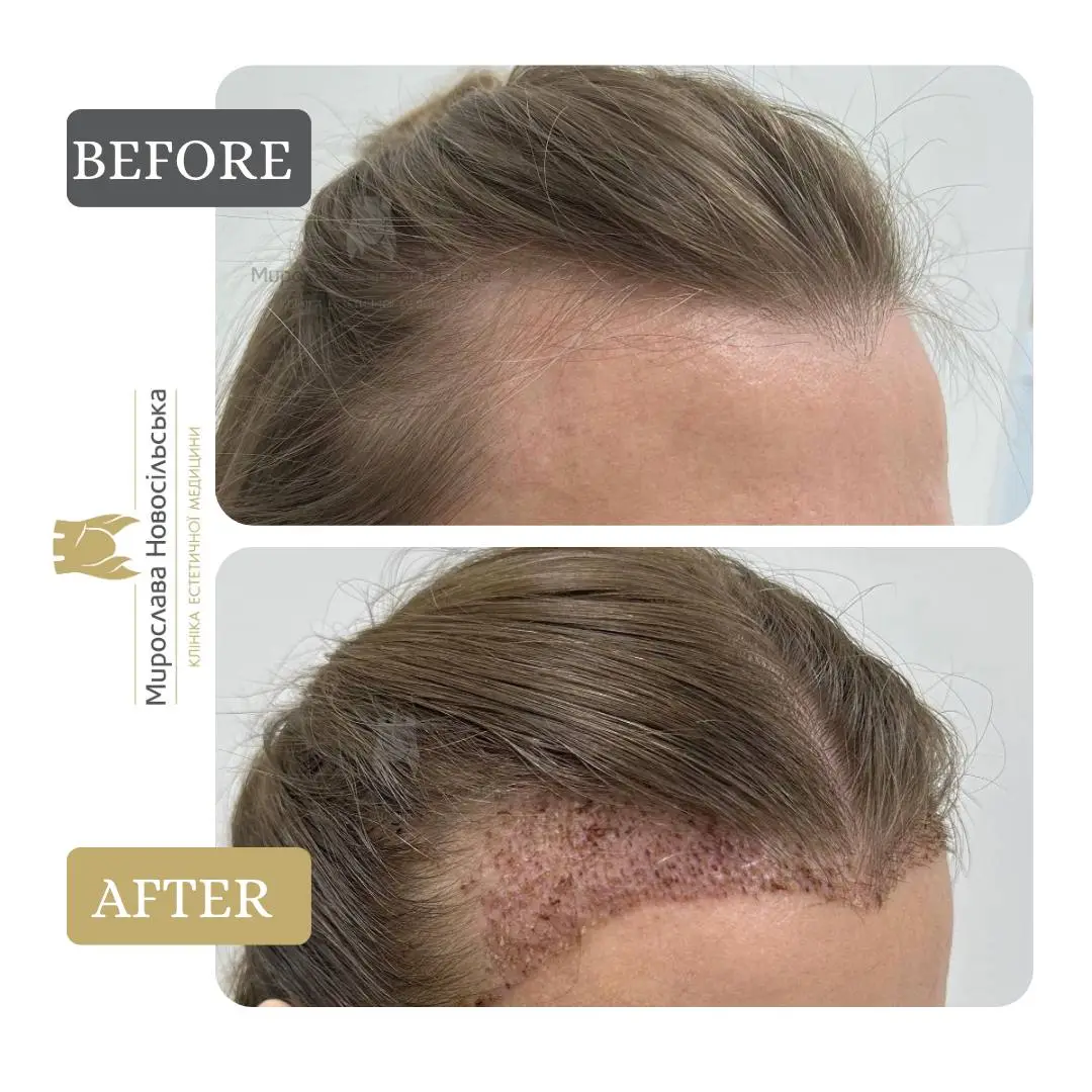 Hair transplantation by the FUE method, photo 11