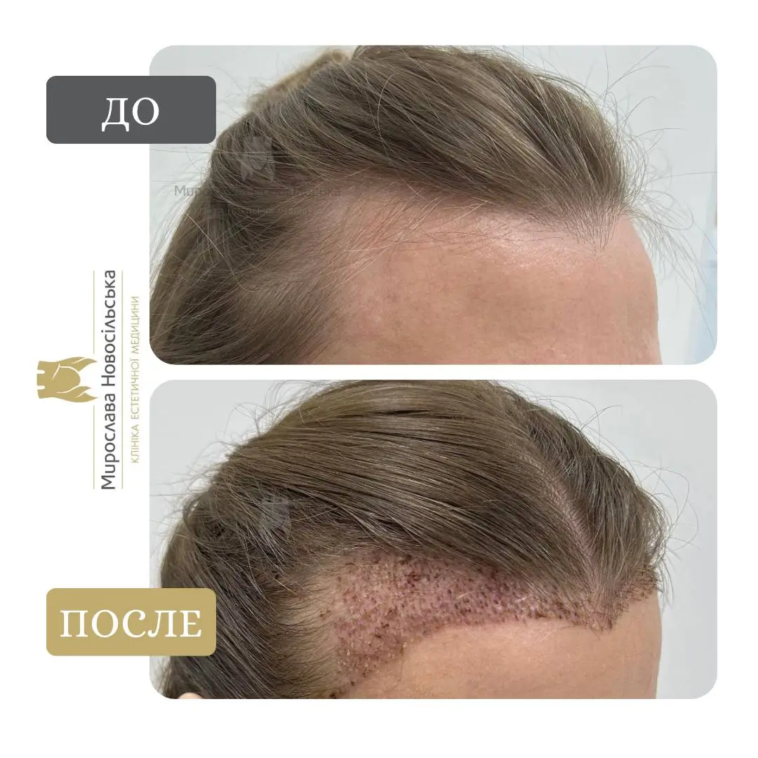 Пересадка волос методом FUE, фото 11
