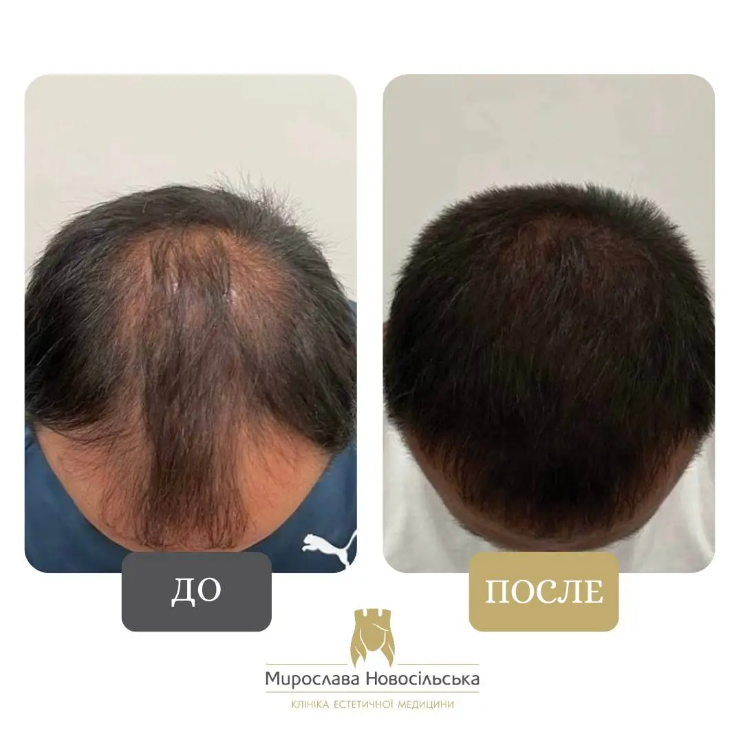 Пересадка волос методом FUE, фото 3