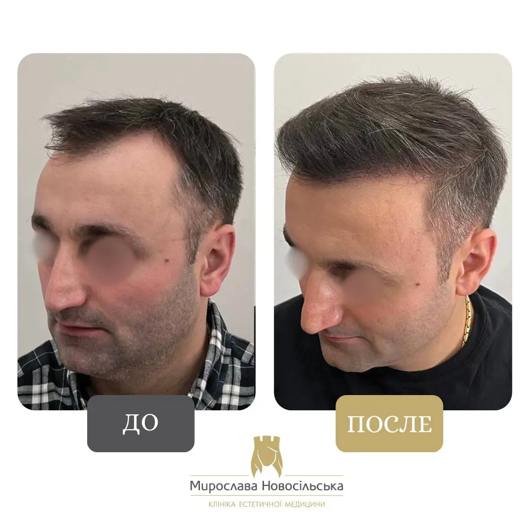 Пересадка волос методом FUE, фото 7