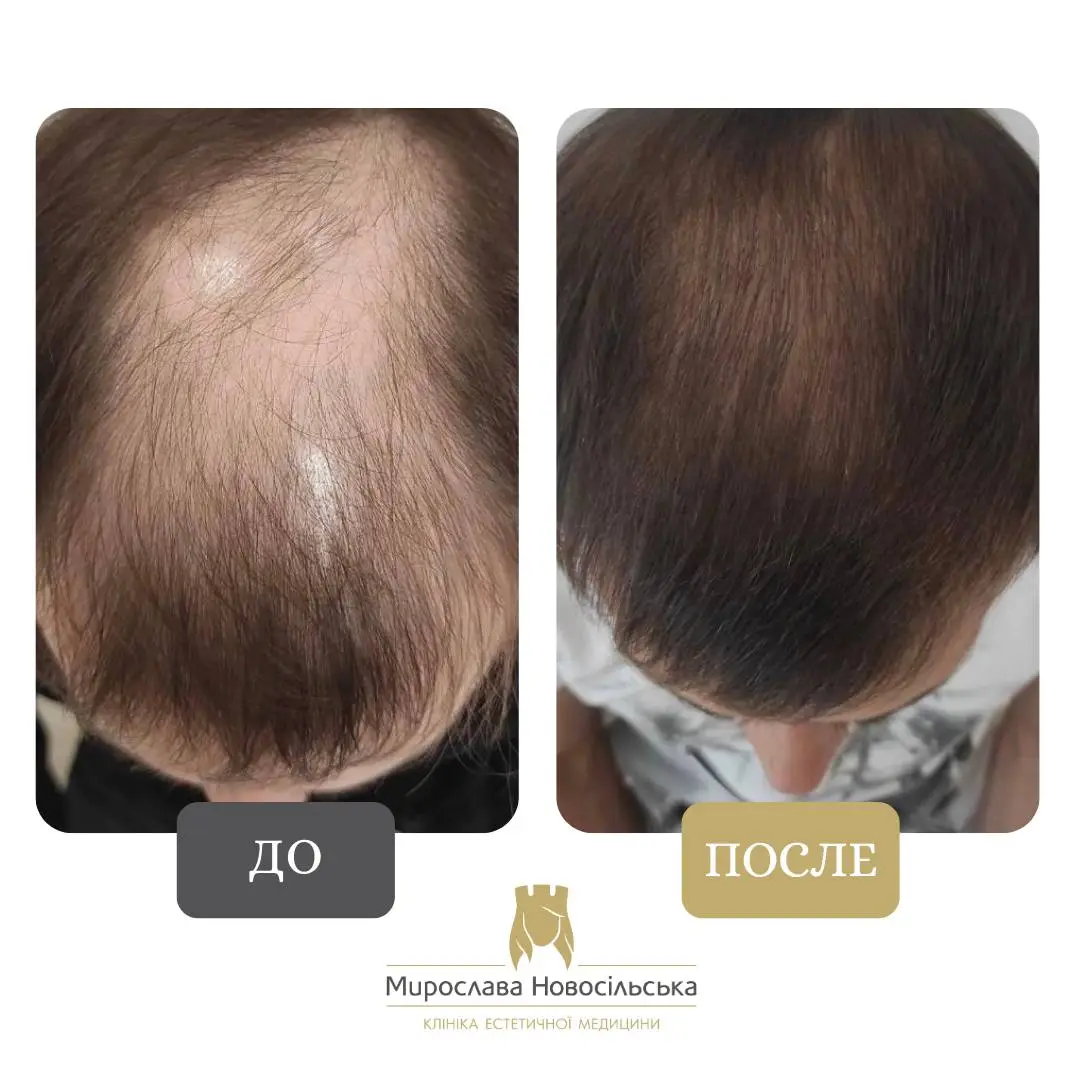 Пересадка волос методом FUE, фото 6