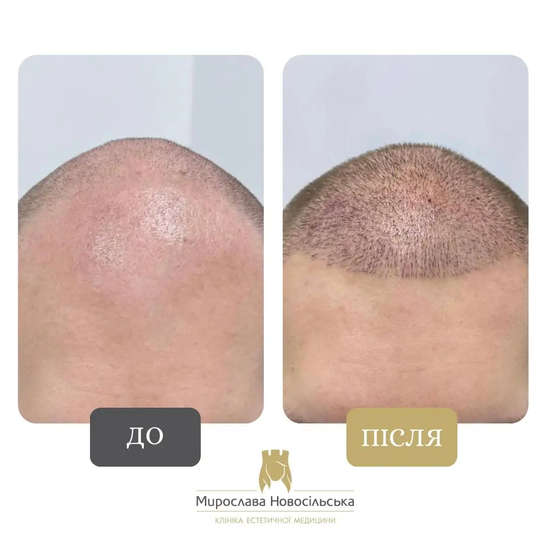 Пересадка волосся методом FUE, фото 9