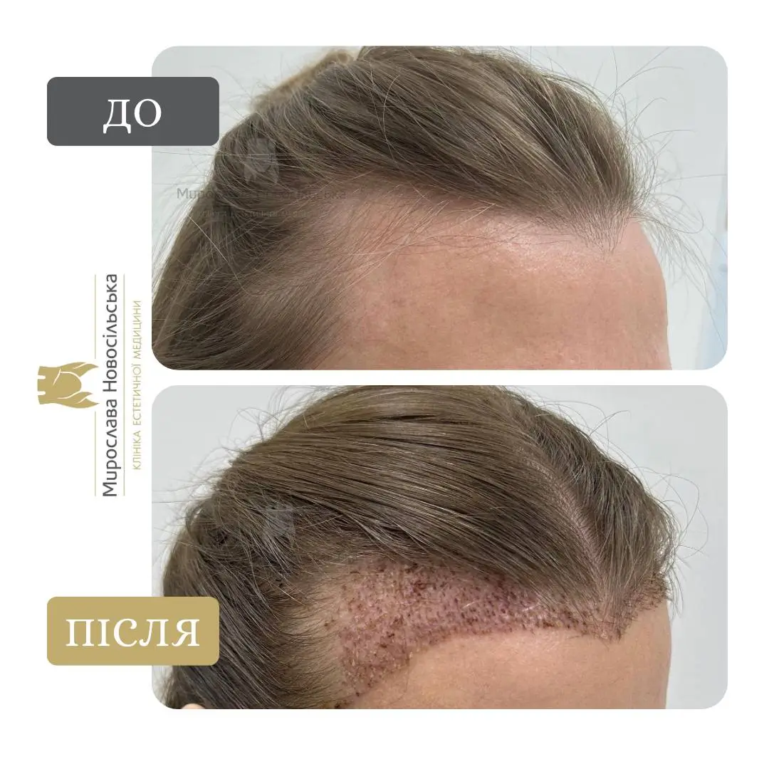 Пересадка волосся методом FUE, фото 11