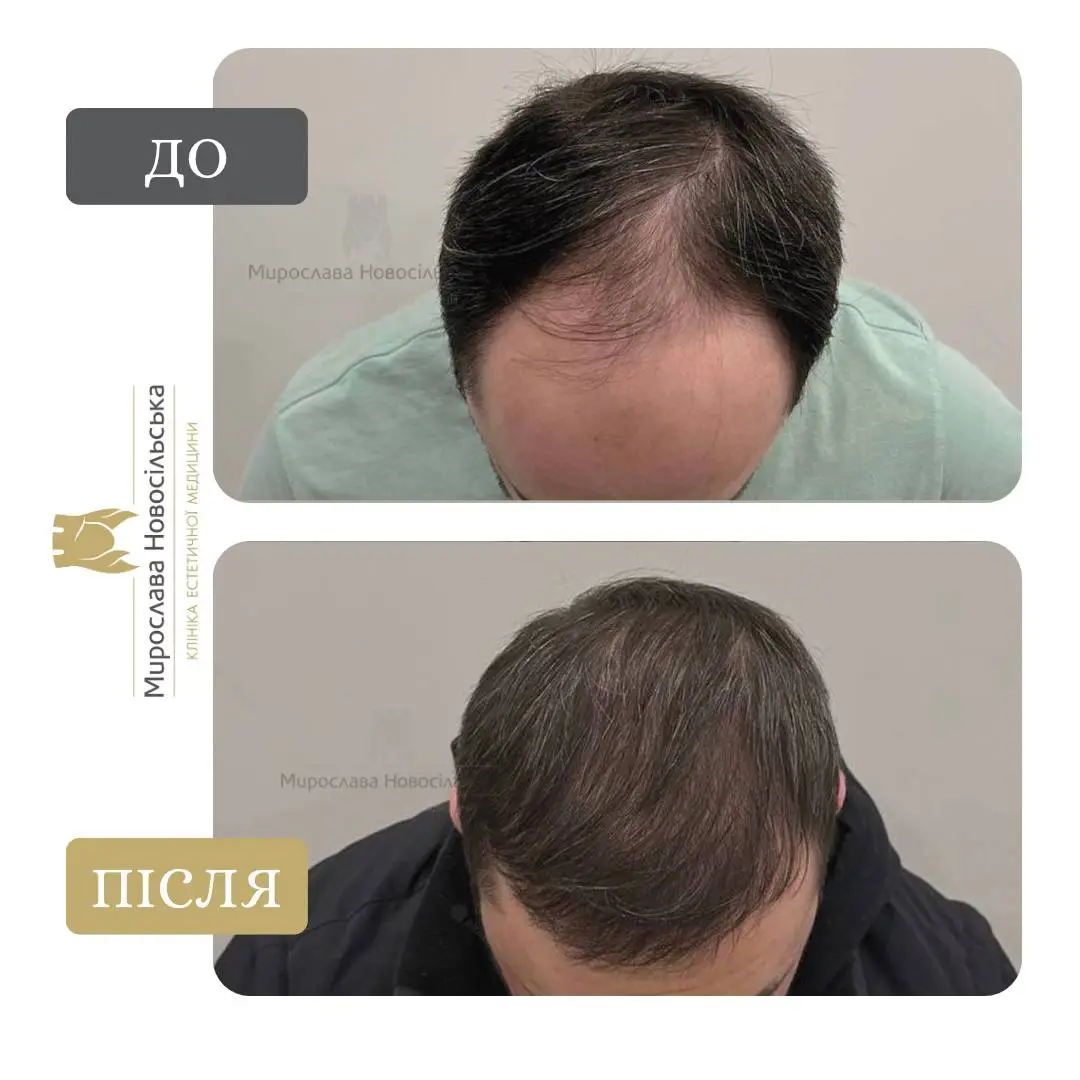 Пересадка волосся методом FUE, фото 2