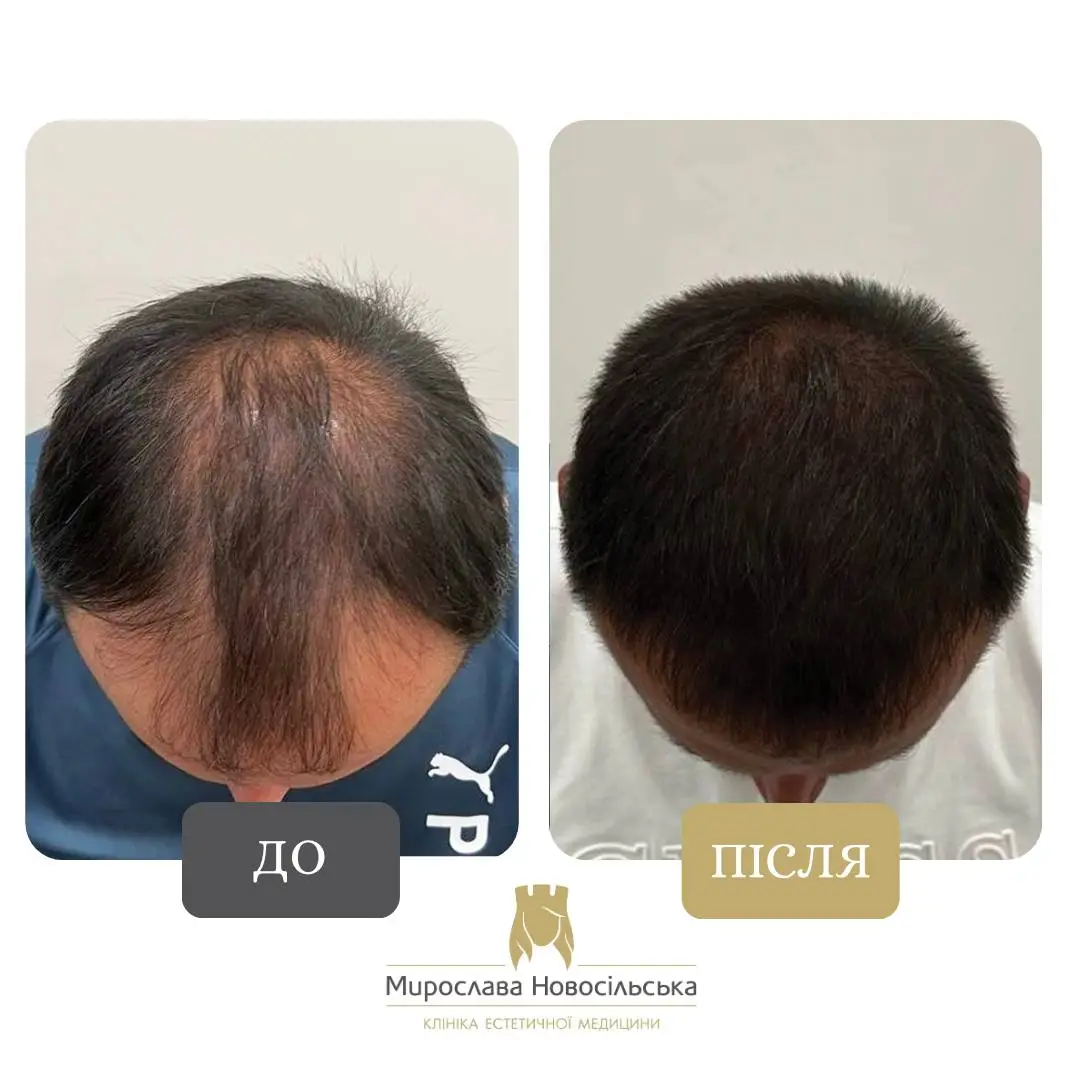 Пересадка волосся методом FUE, фото 3