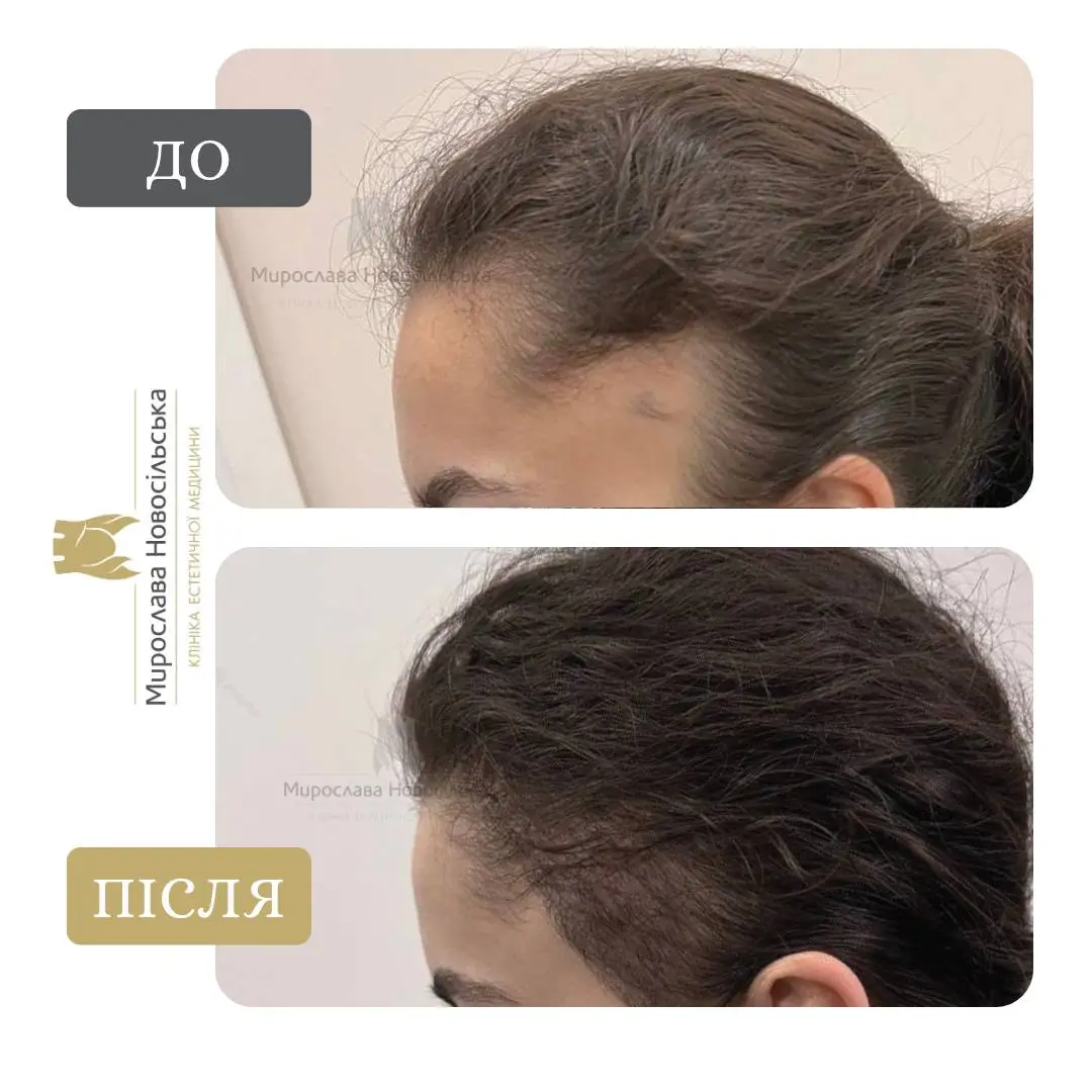 Пересадка волосся методом FUE, фото 4