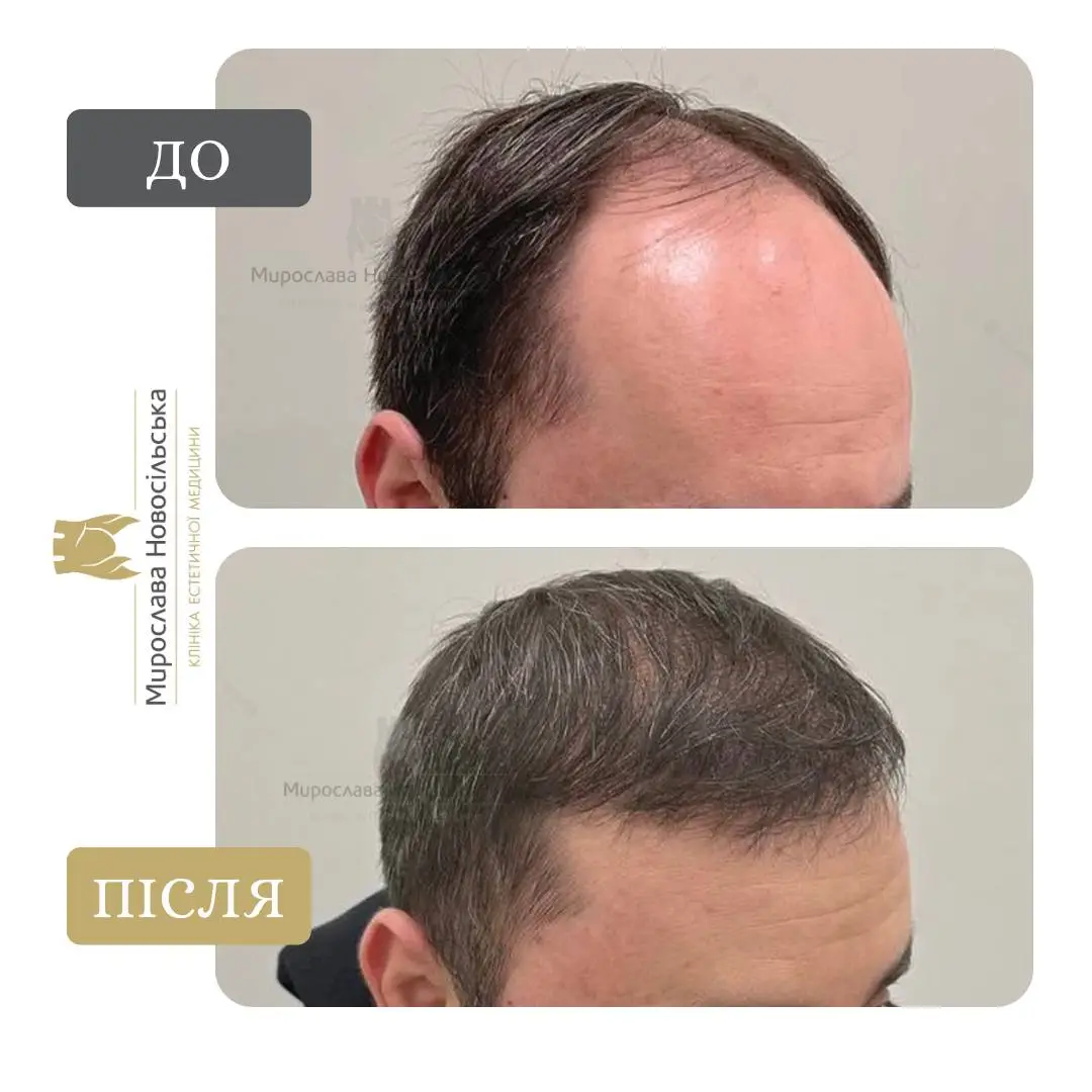 Пересадка волосся методом FUE, фото 5