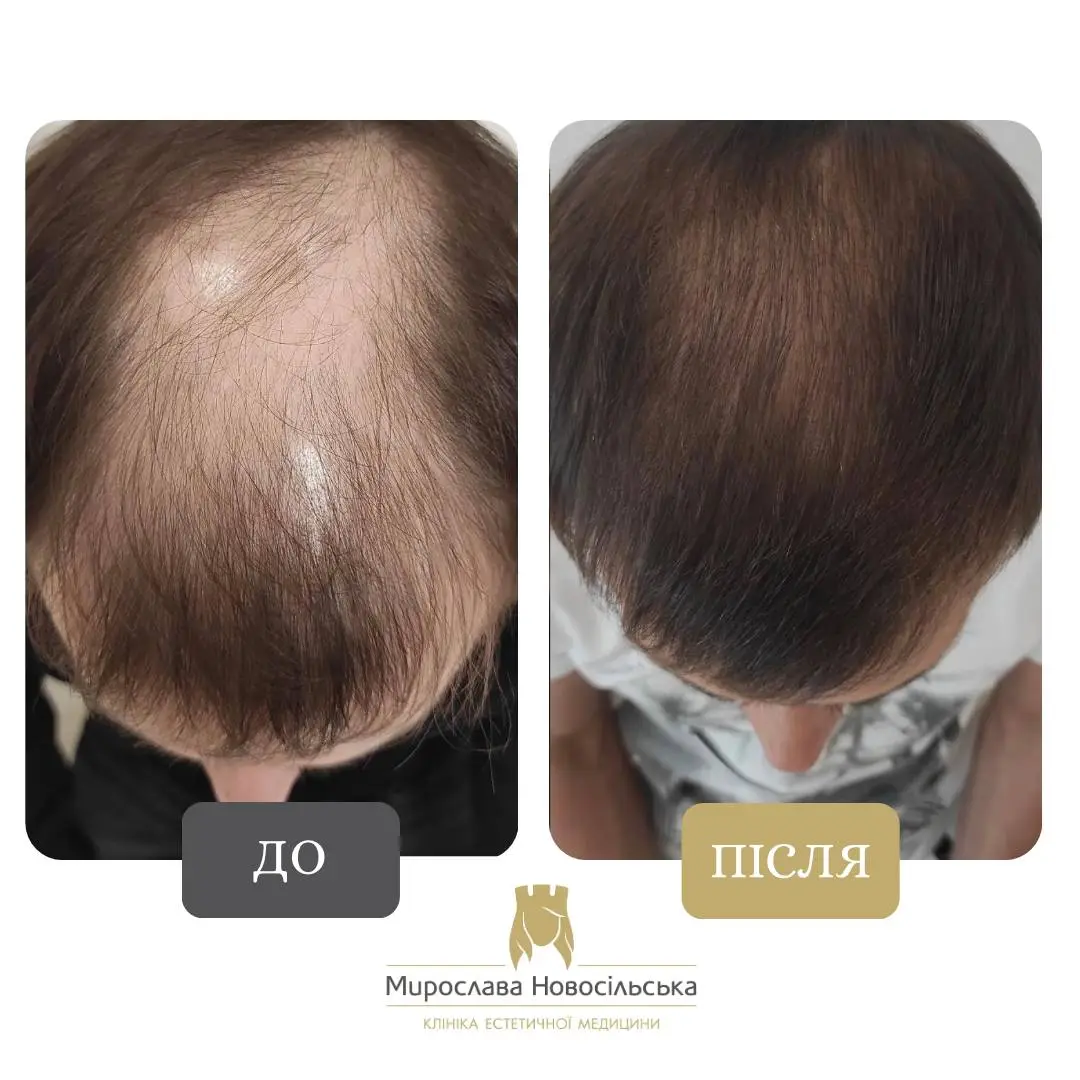 Пересадка волосся методом FUE, фото 6