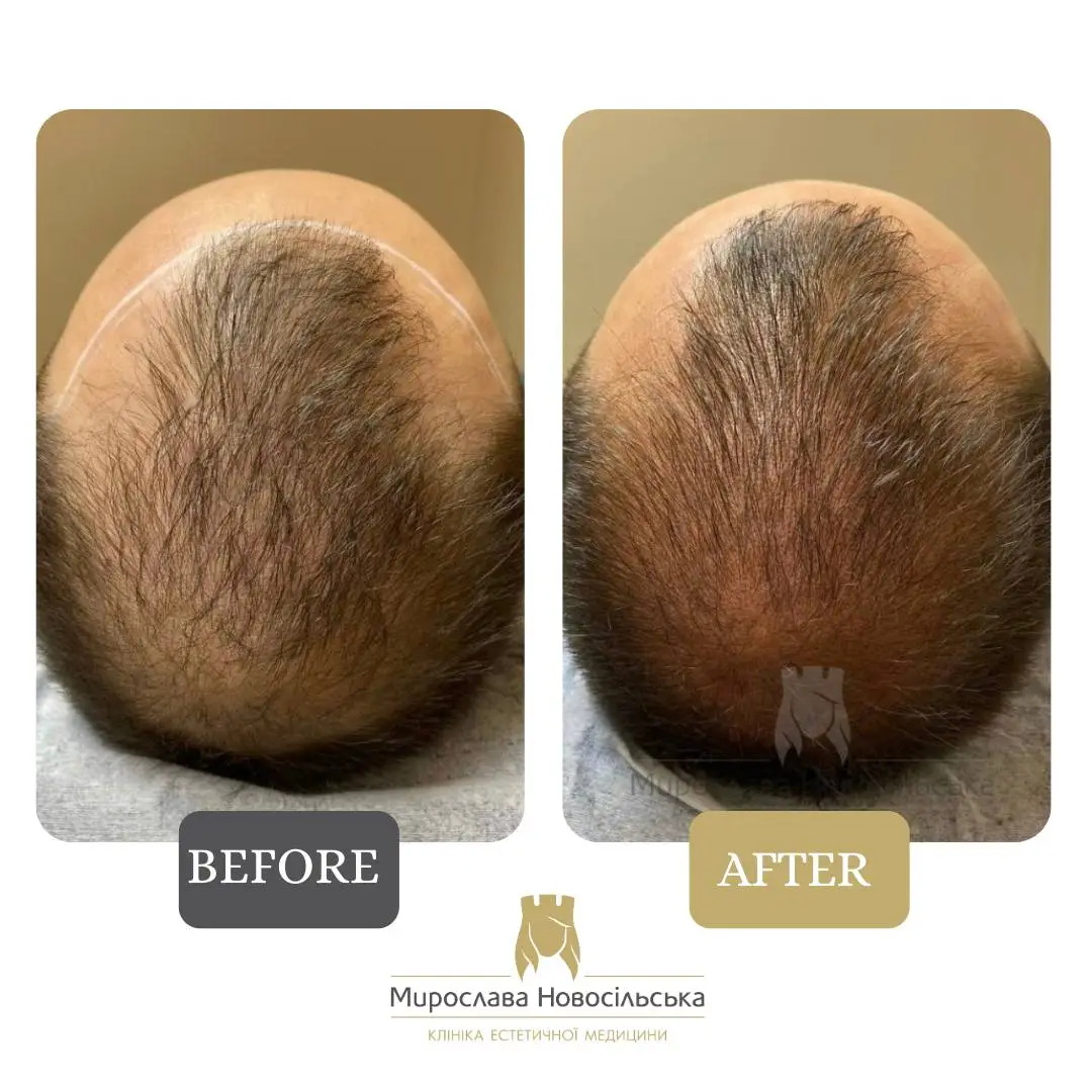 Trichopigmentation, photo 3