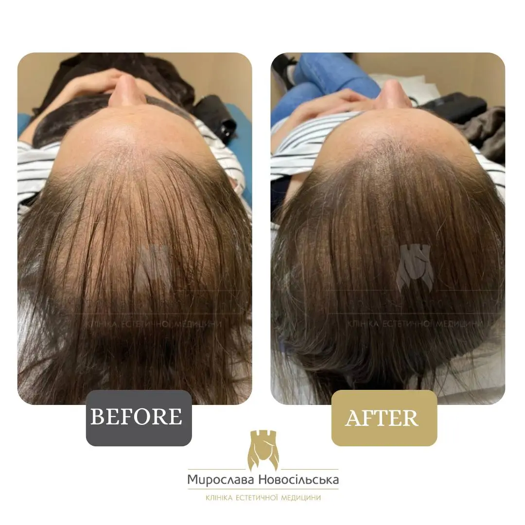 Trichopigmentation, photo 4