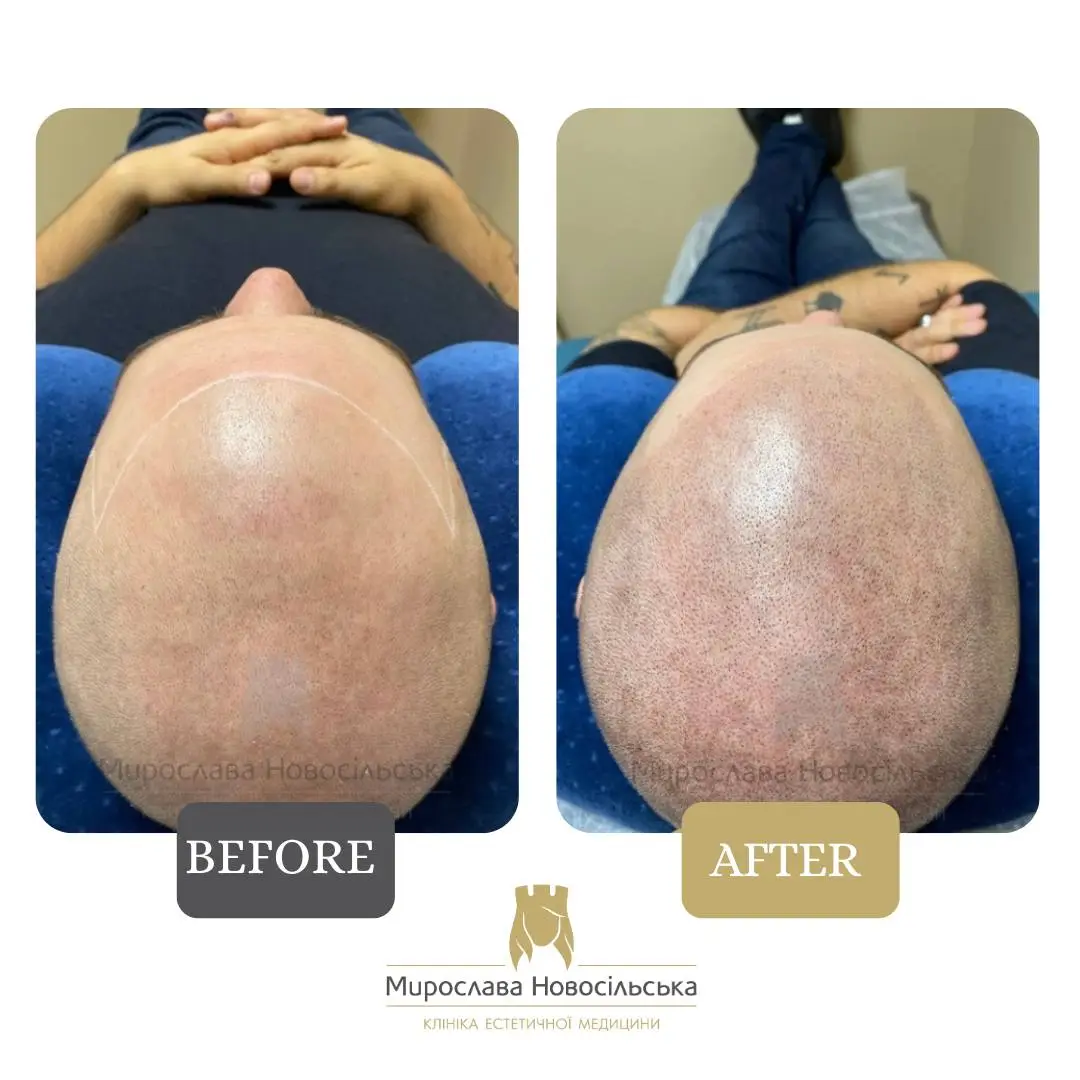 Trichopigmentation, photo 5