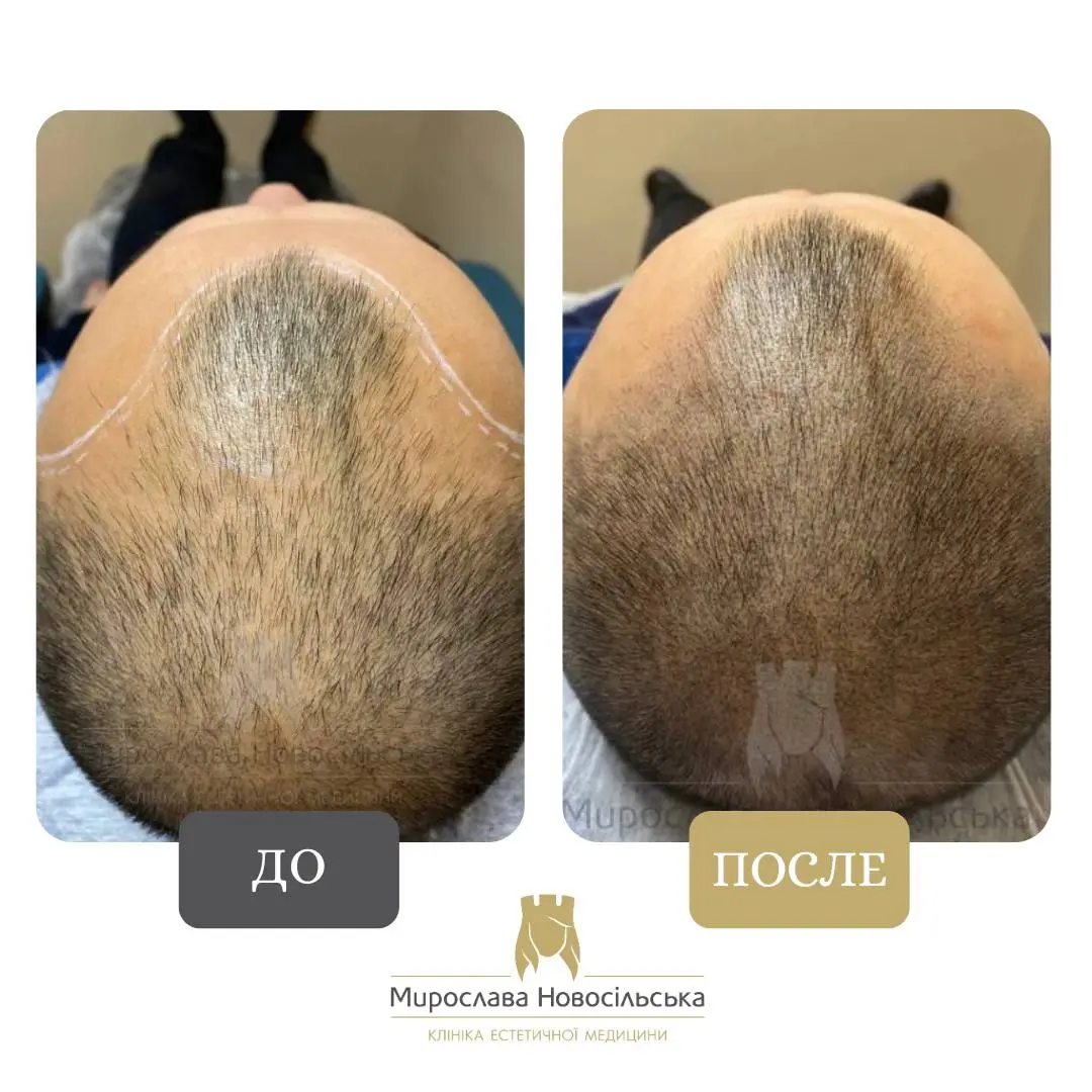 Трихопигментация, фото 6