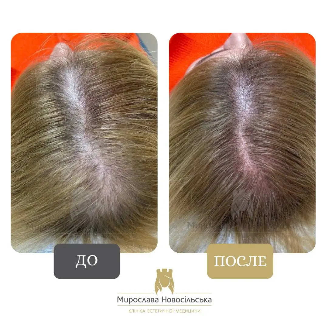 Трихопигментация, фото 2