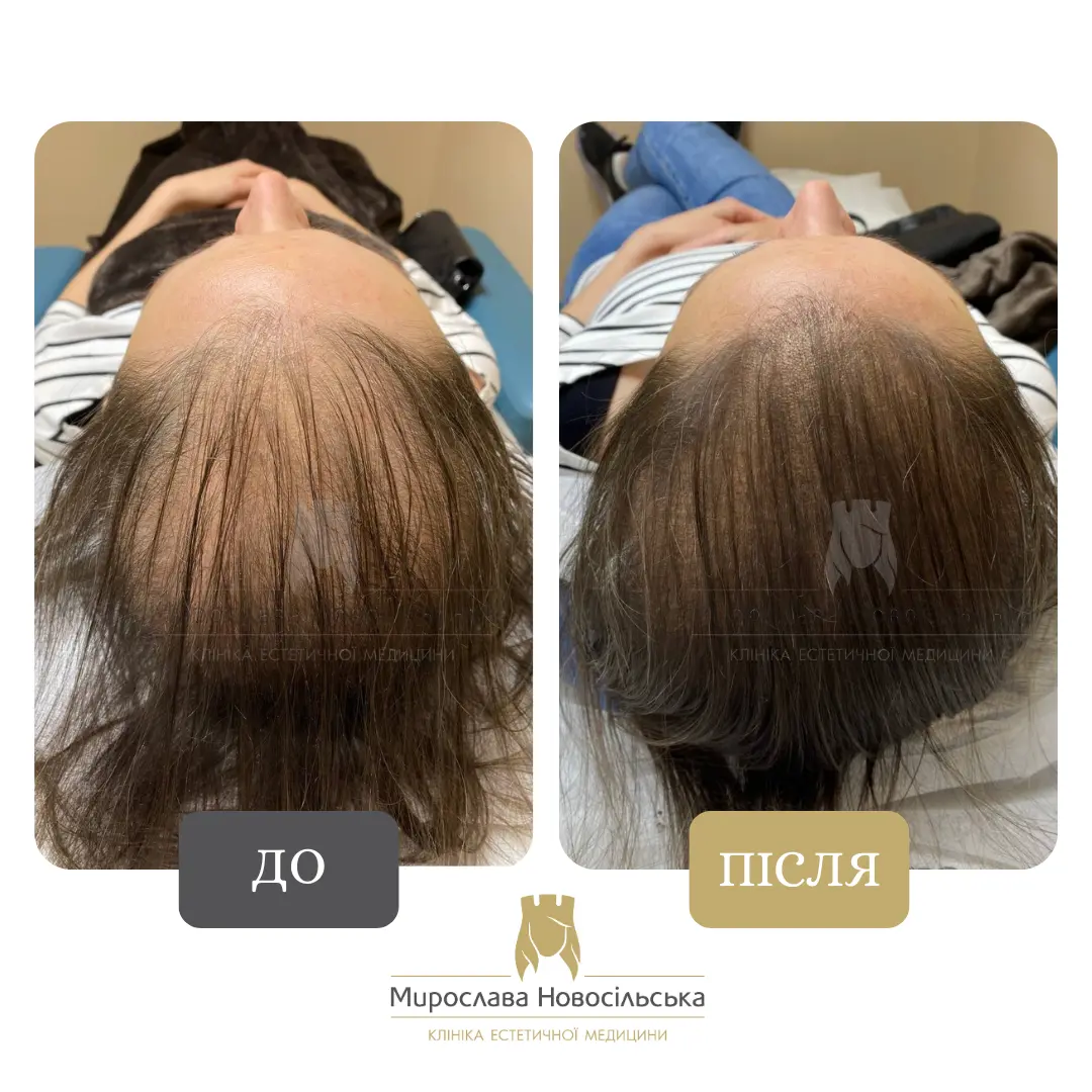 Трихопігментація, фото 4