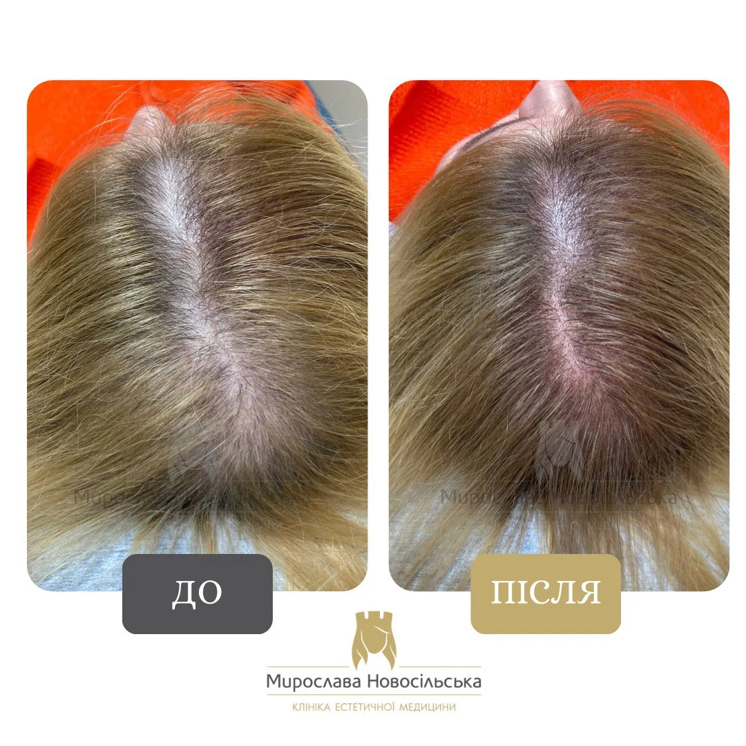 Трихопігментація, фото 2