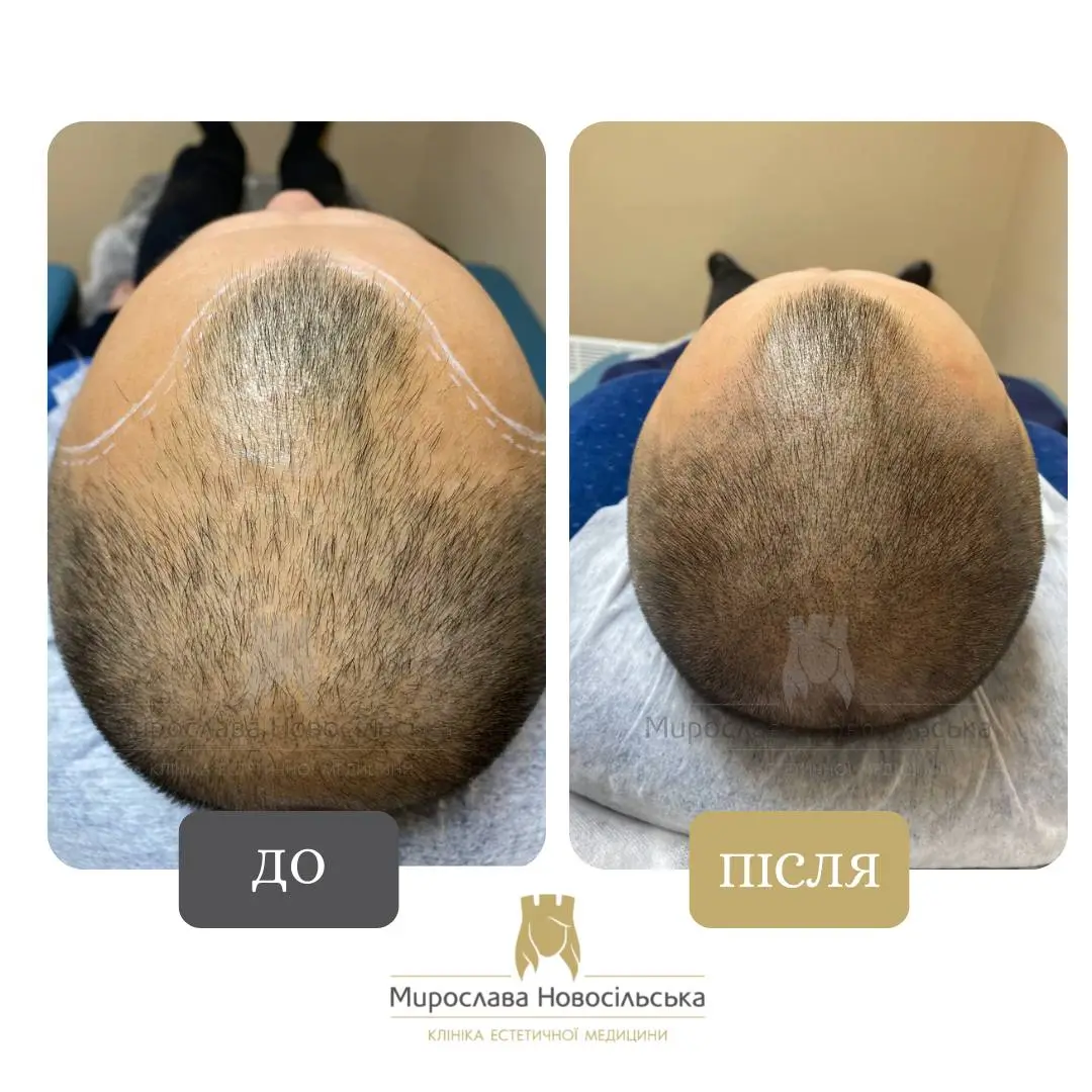 Трихопігментація, фото 6