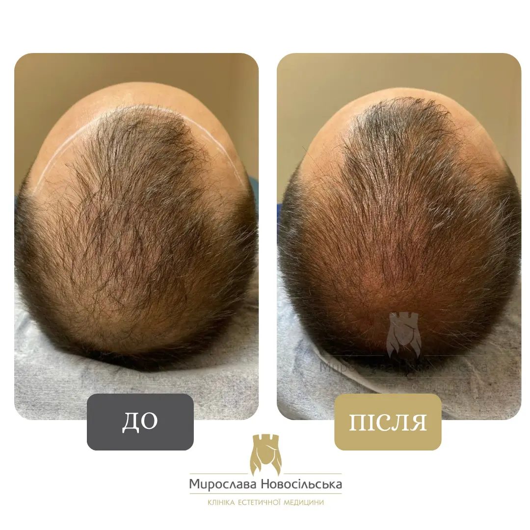 Трихопігментація, фото 3