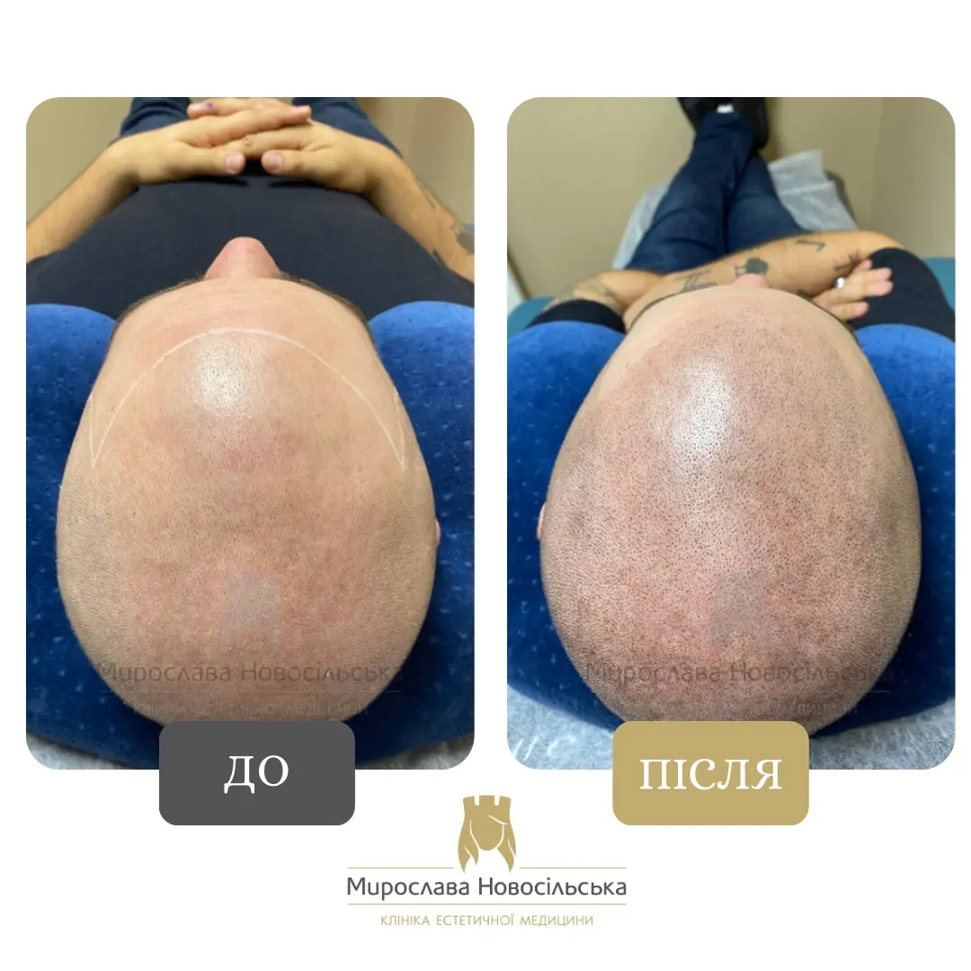 Трихопігментація, фото 5