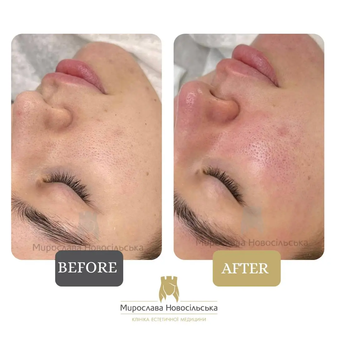 Ultrasonic cleansing