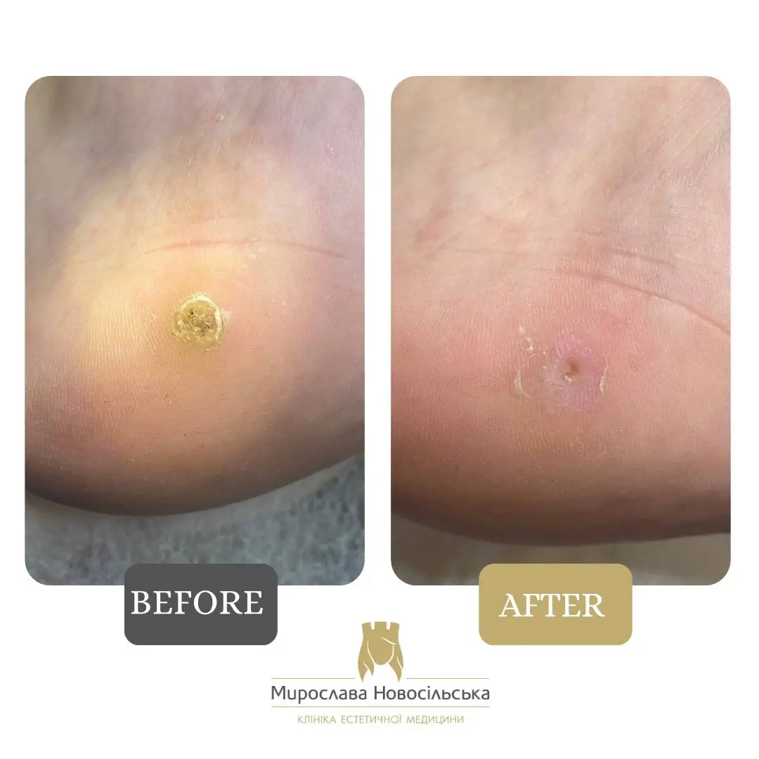 Freezing of warts, photo 9