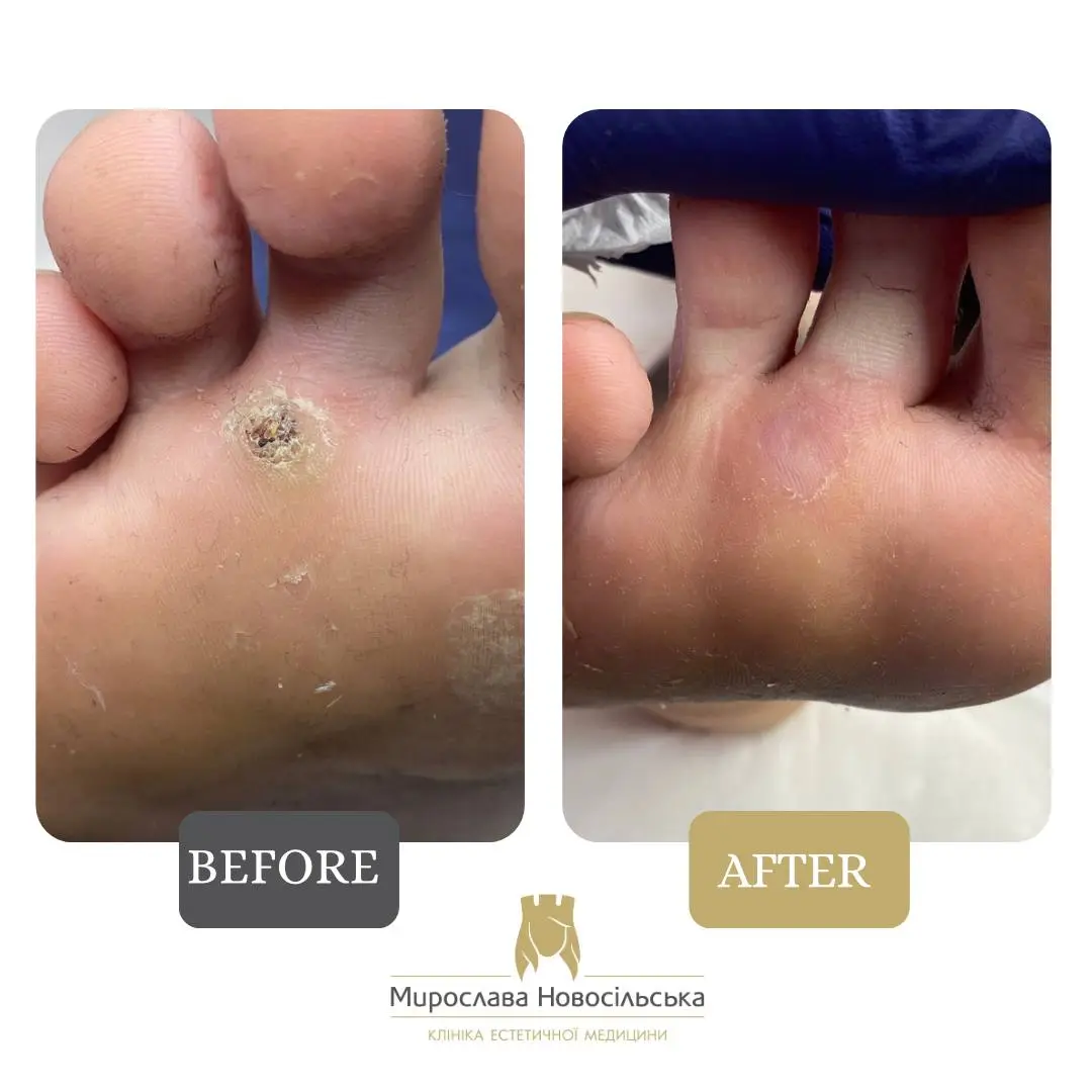 Freezing of warts, photo 11