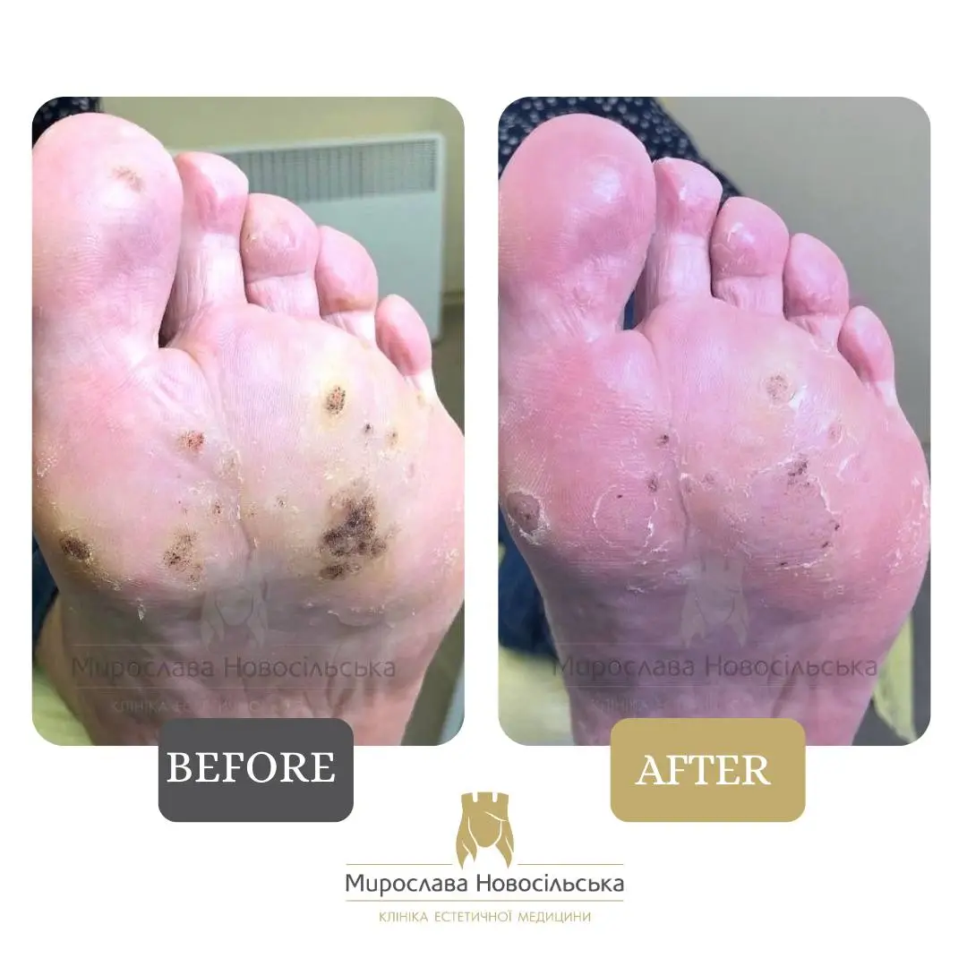 Freezing of warts, photo 6