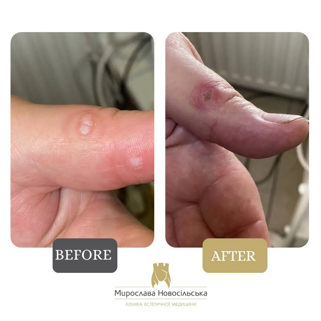 Freezing of warts, photo 12