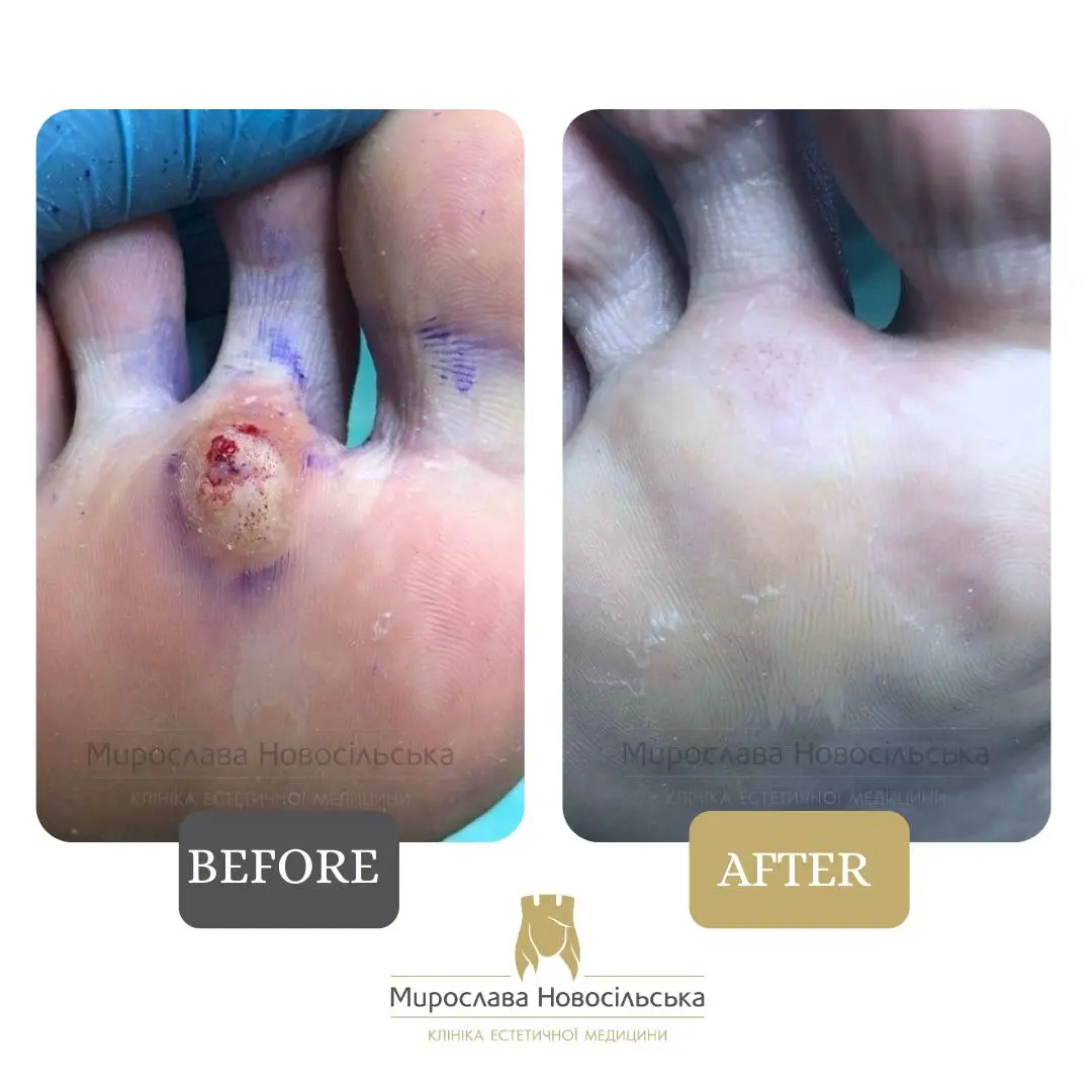 Freezing of warts, photo 3