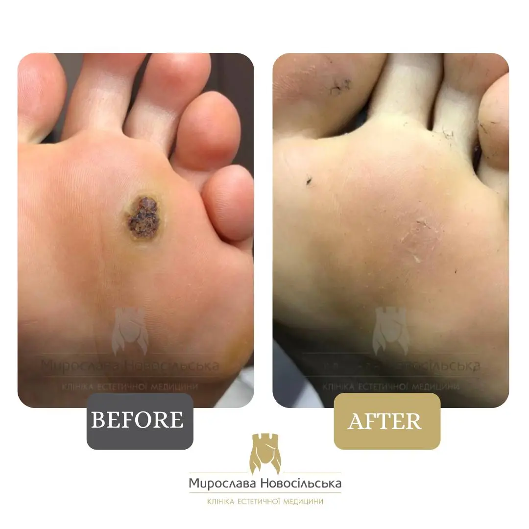 Freezing of warts, photo 4