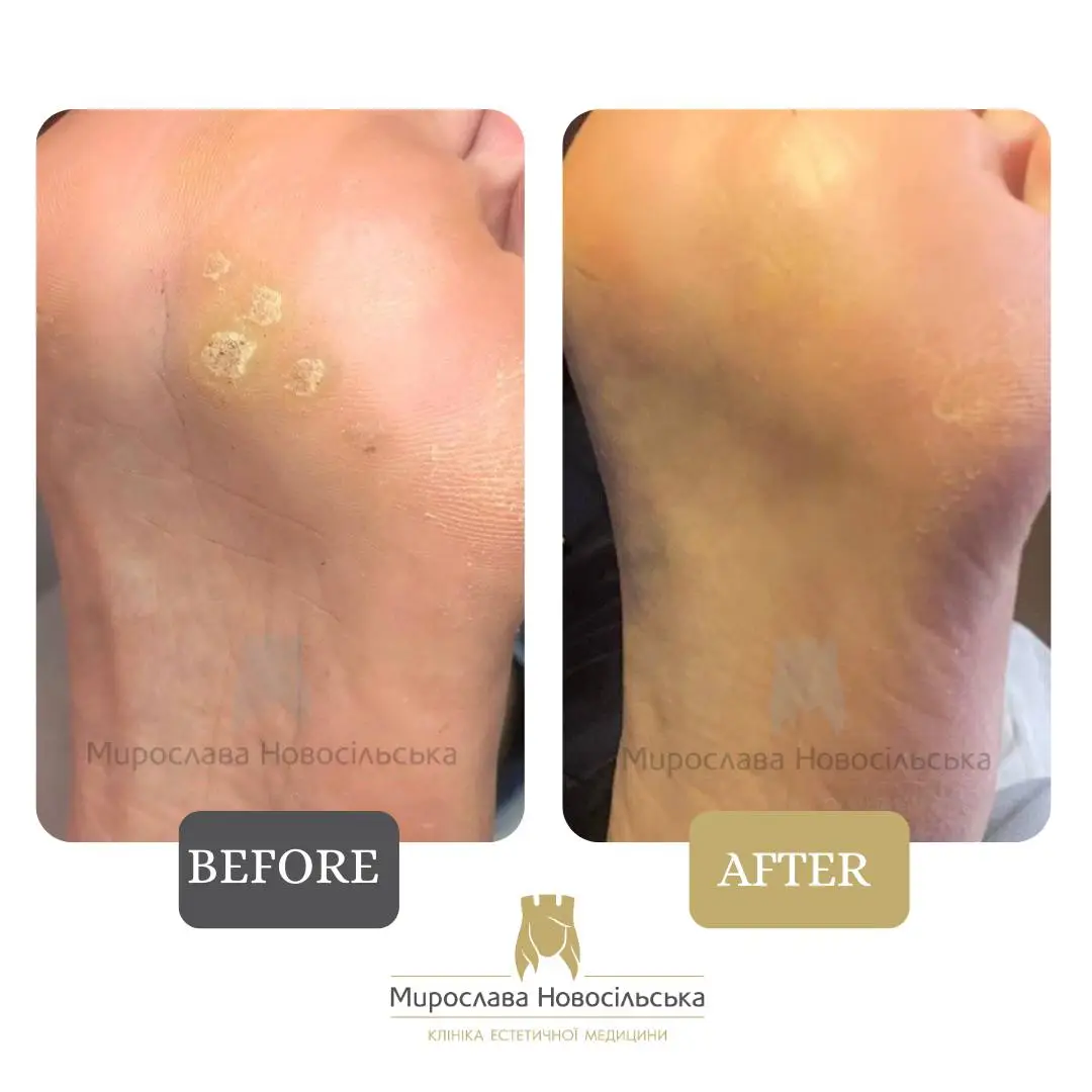 Freezing of warts, photo 5